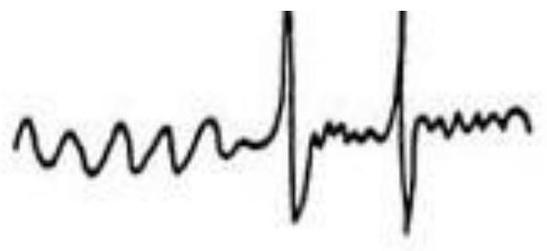 Epilepsy prediction system and method based on electrical impedance imaging and EEG signals