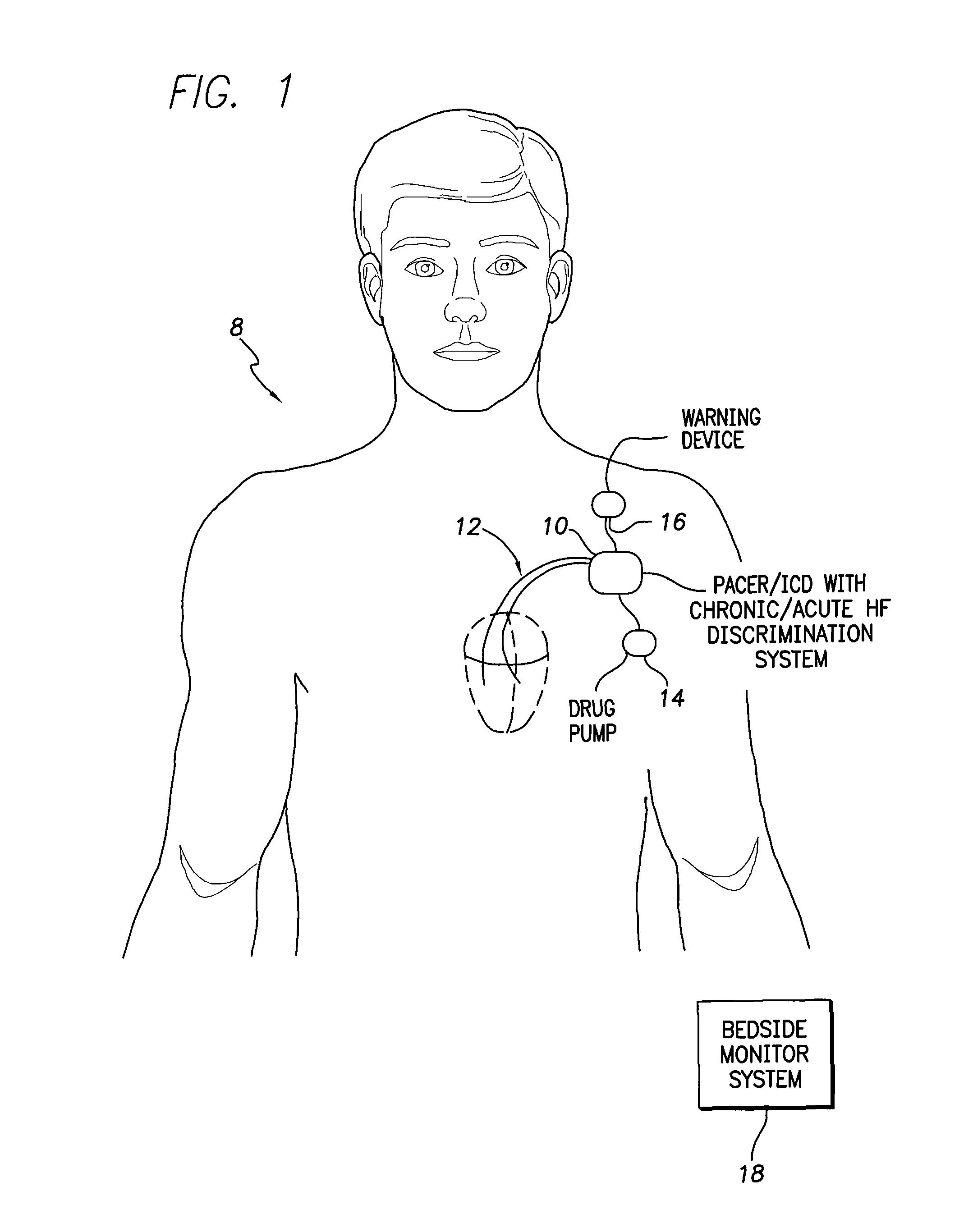 System and method for discriminating acute and chronic heart failure using an implantable medical device