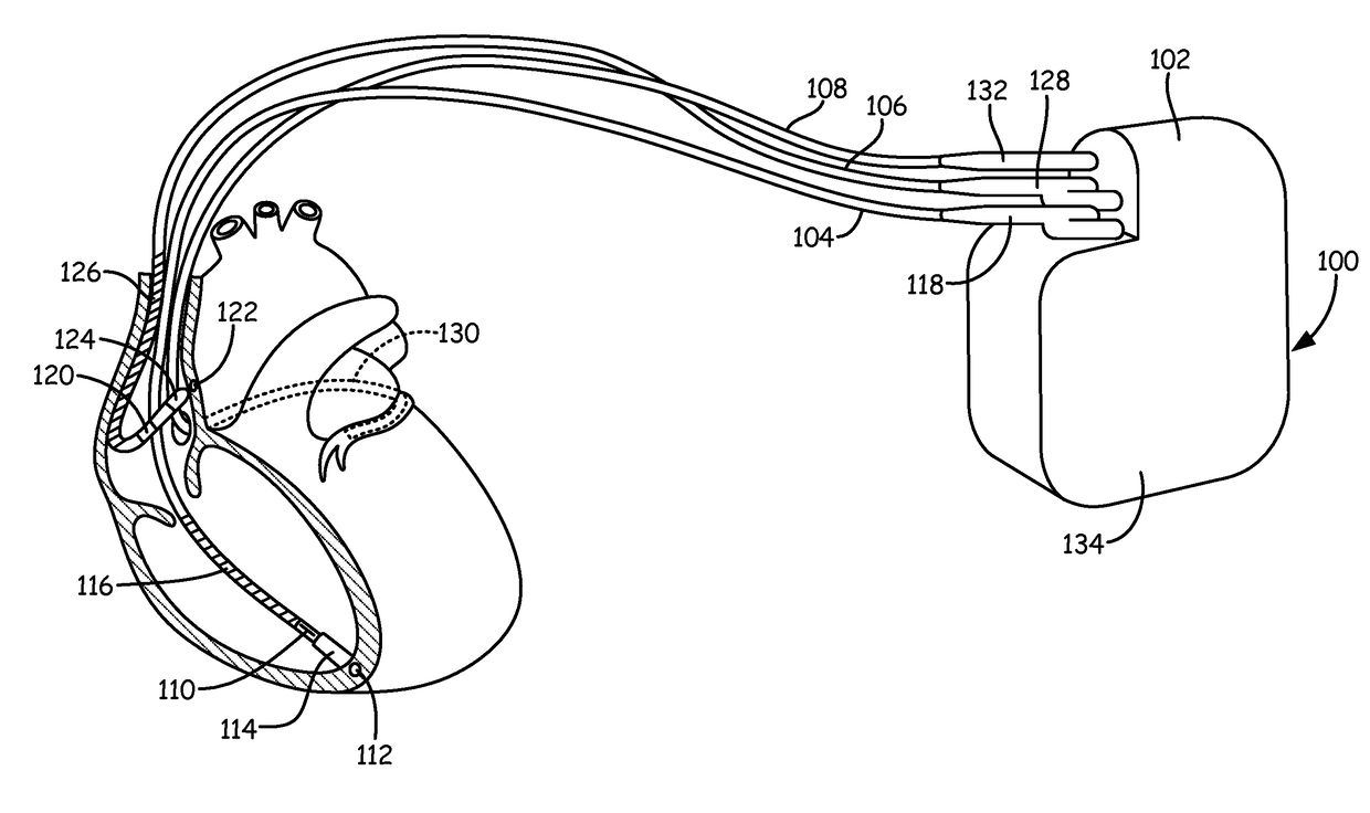 Method and apparatus for verifying bradycardia/asystole episodes via detection of under-sensed events