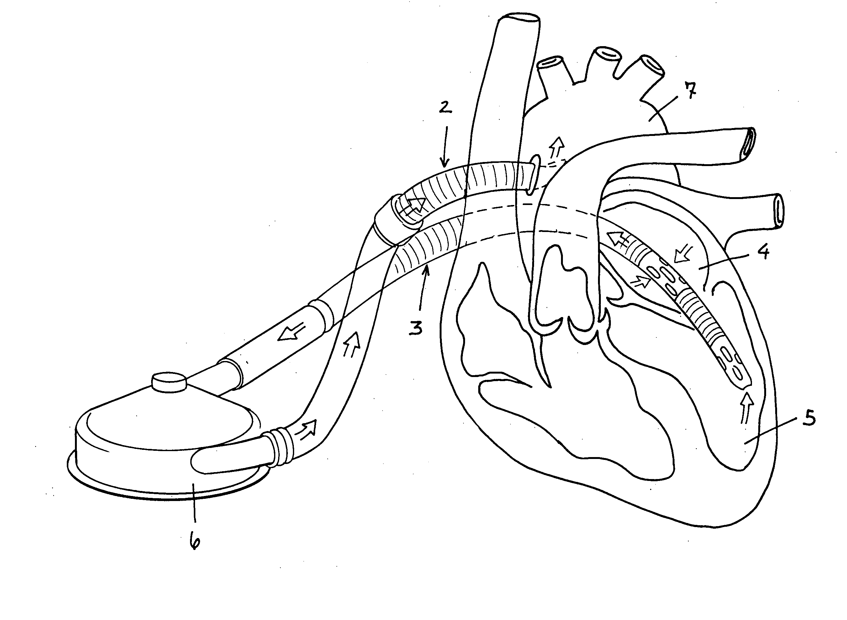 Apparatus for performing myocardial revascularization in a beating heart and left ventricular assistance condition