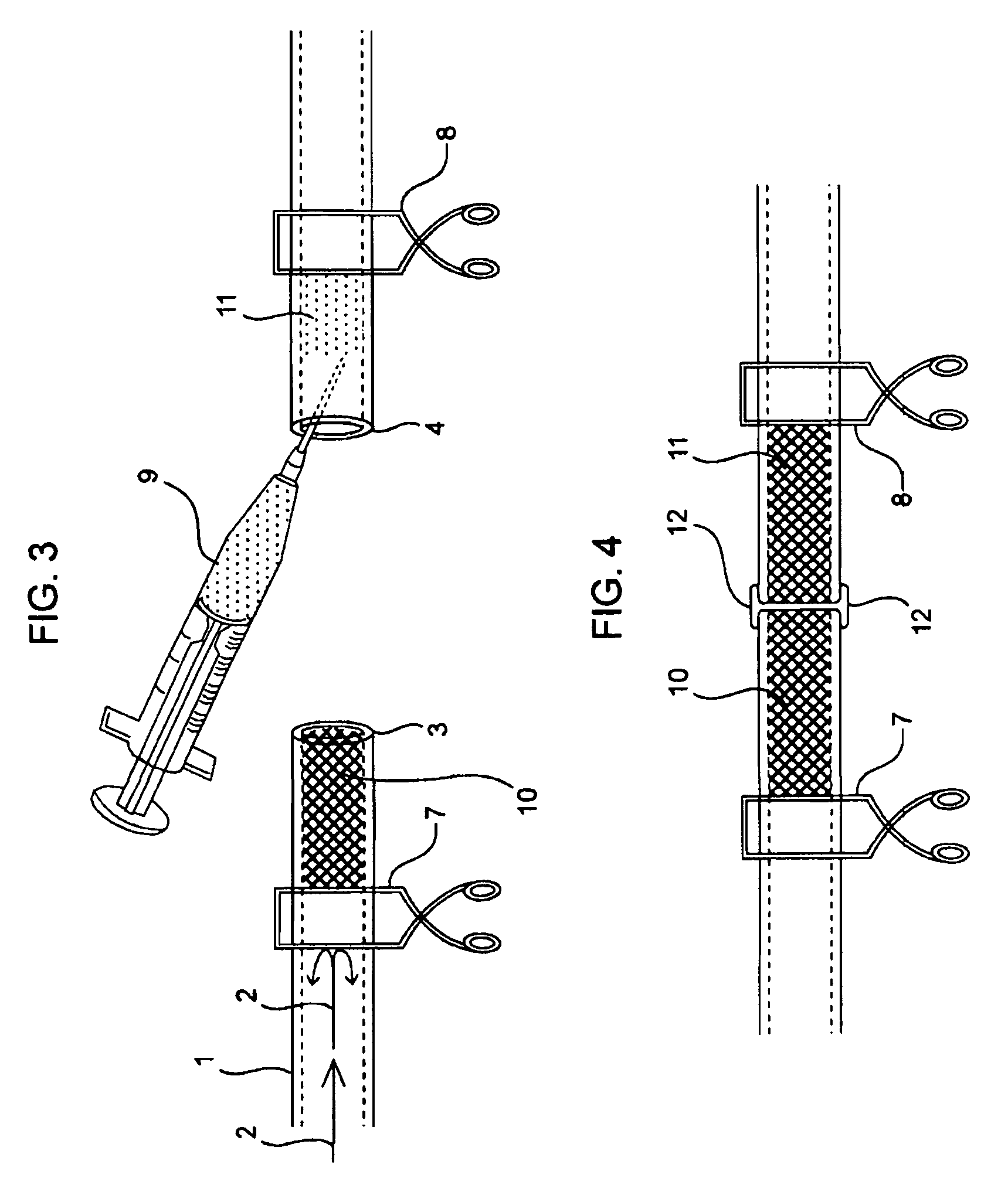 Compositions and methods for joining non-conjoined lumens