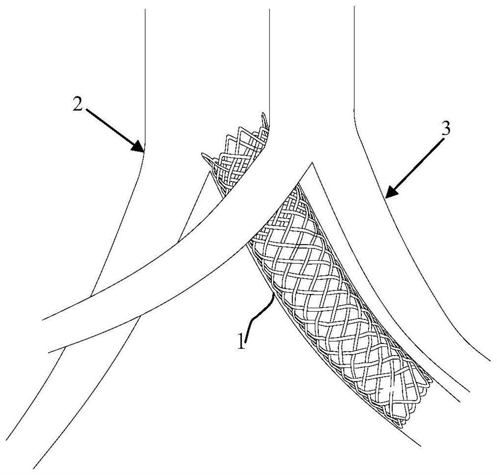 Vein vascular stent