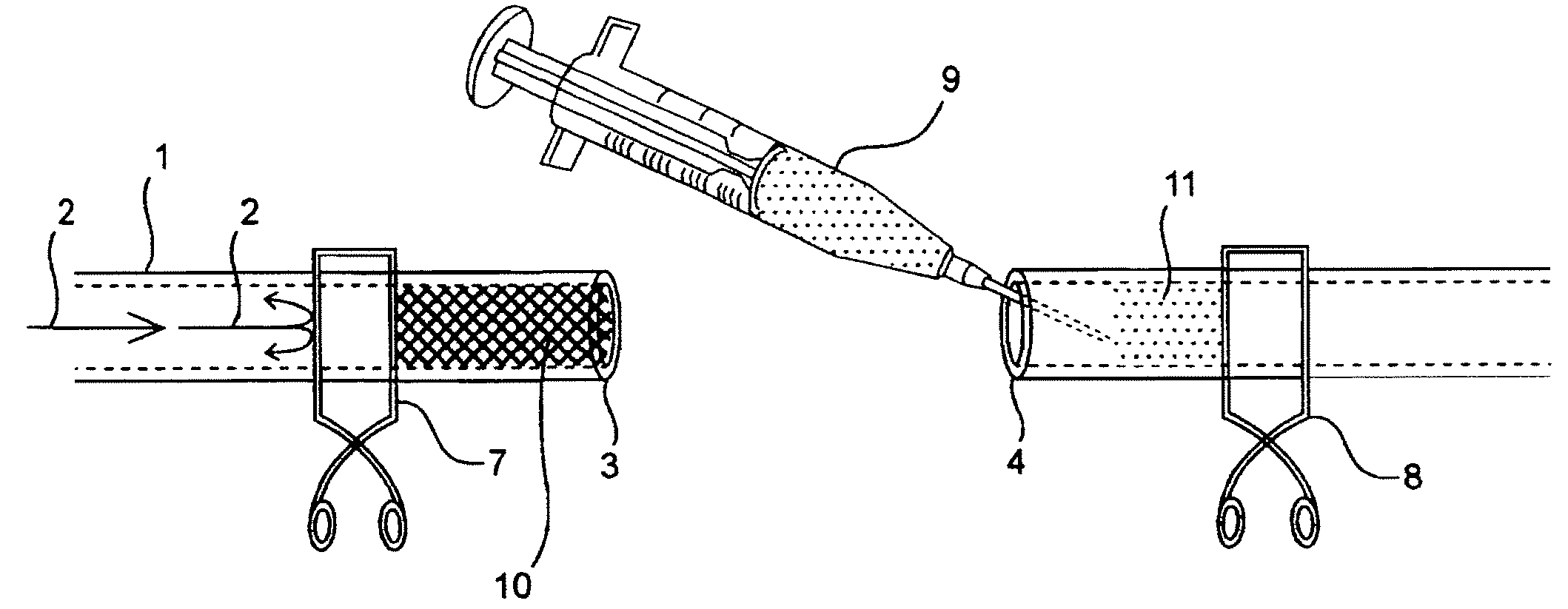 Compositions and methods for joining non-conjoined lumens