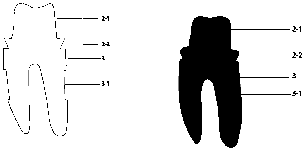 Personalized bionic implant for synchronously repairing tooth and peripheral alveolar bone defects and forming method thereof