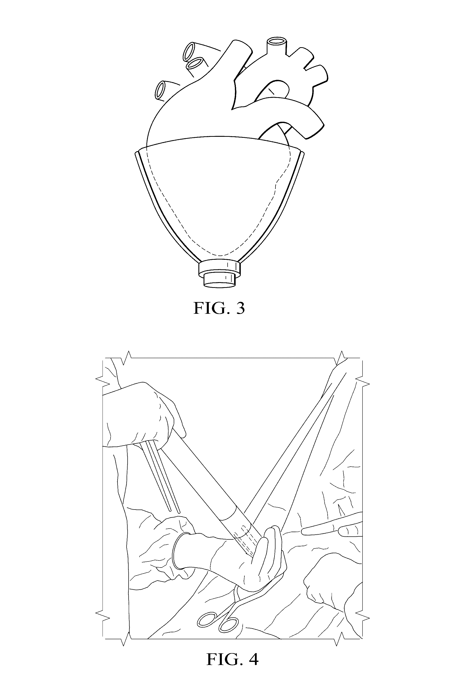 Deployment methods and mechanisms for minimally invasive implantation of heart contacting cardiac devices