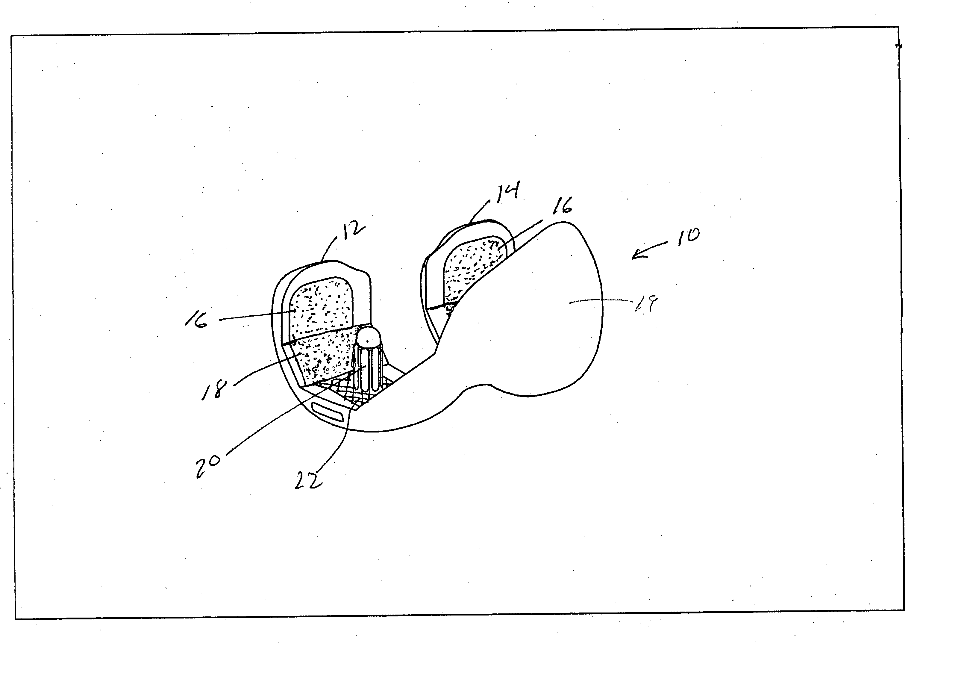 Hybrid femoral implant