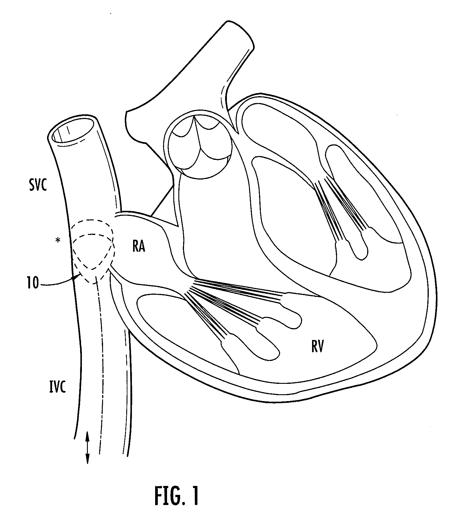 Variable occlusional balloon catheter assembly