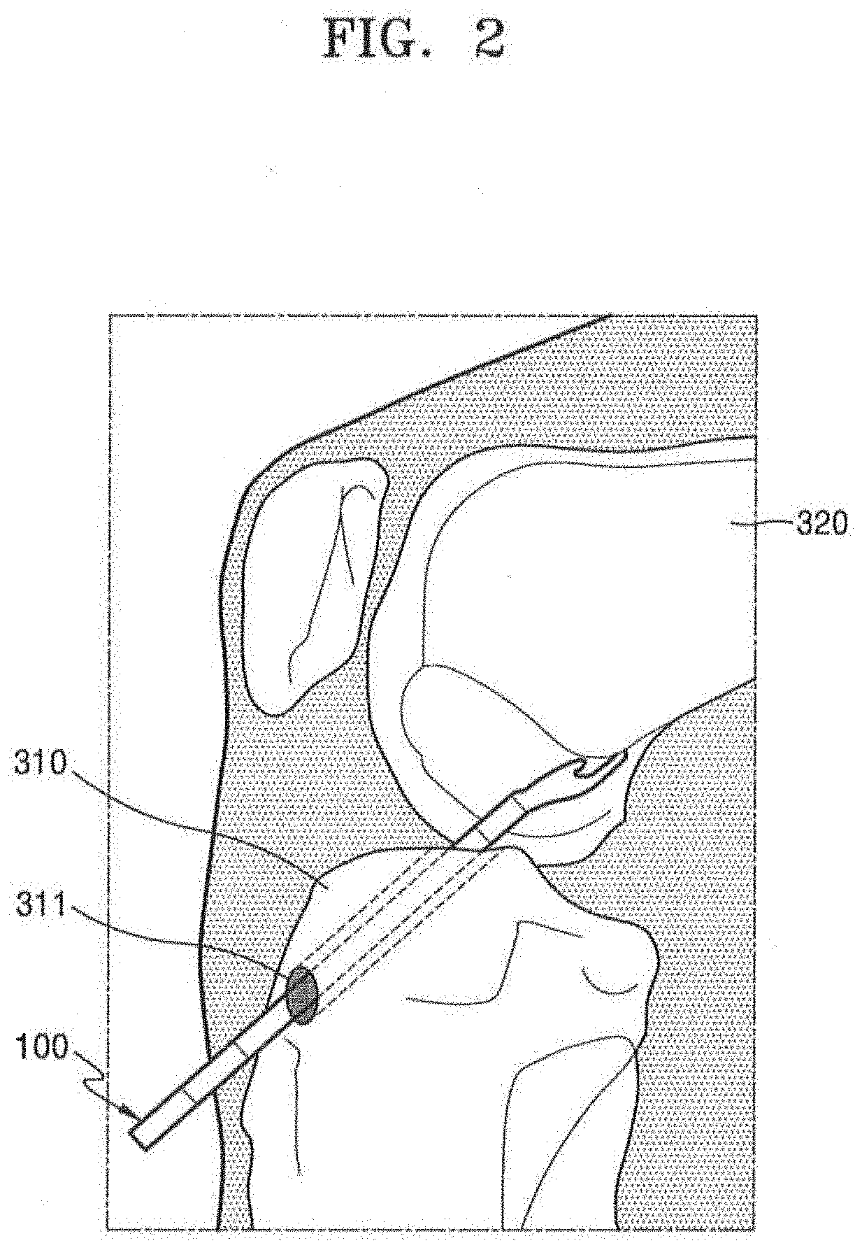 Femoral Tunnel Guide Device