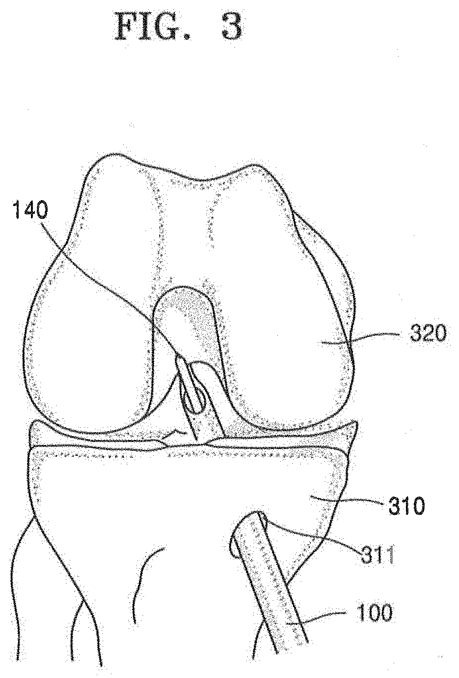 Femoral Tunnel Guide Device