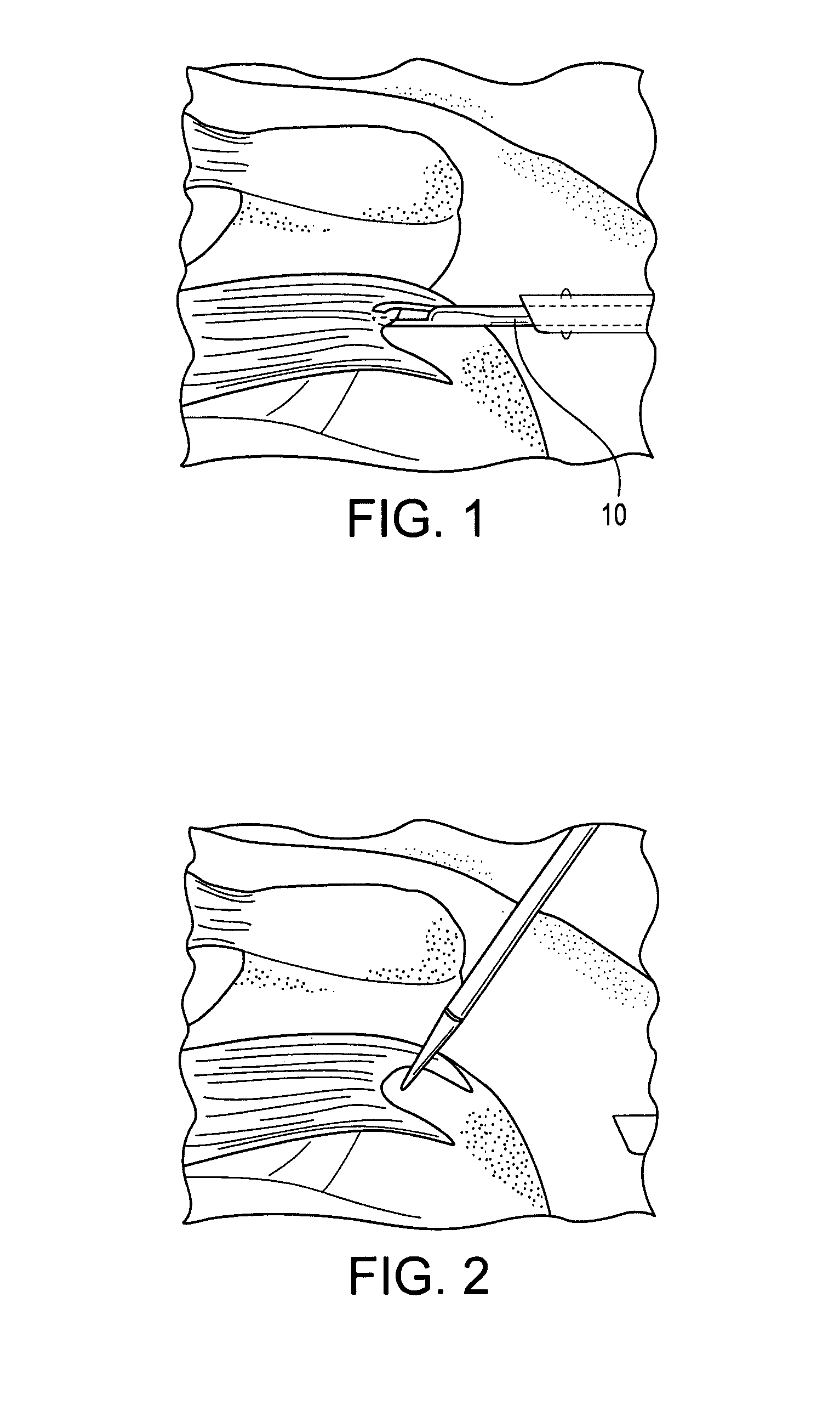 Method for double row fixation of tendon to bone