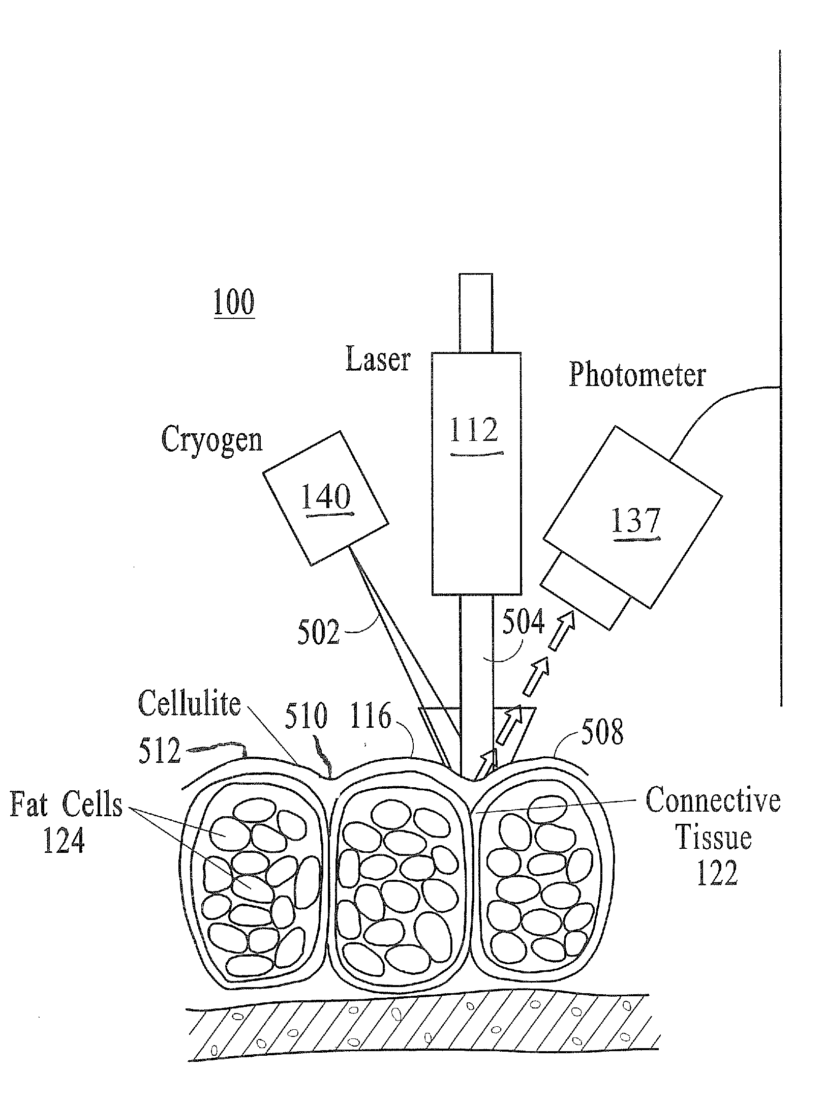 Treatment of cellulite with mid-infrared radiation