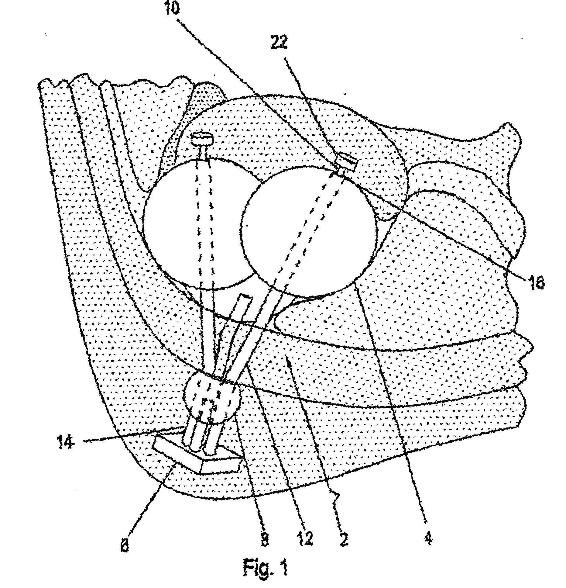 Compressive device for percutaneous treatment of obesity