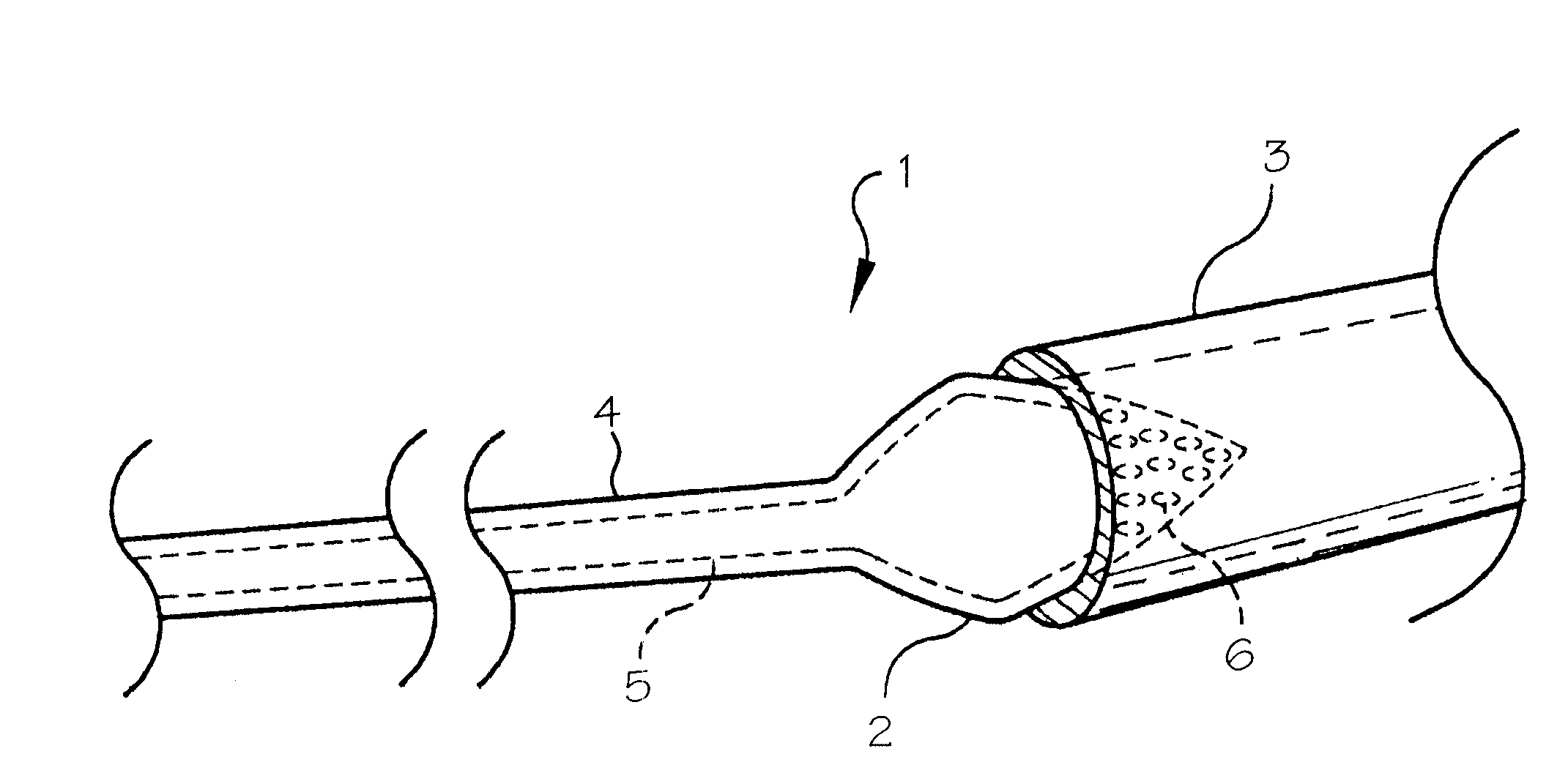 Pulmonary vein arrhythmia diagnostic device and method for use