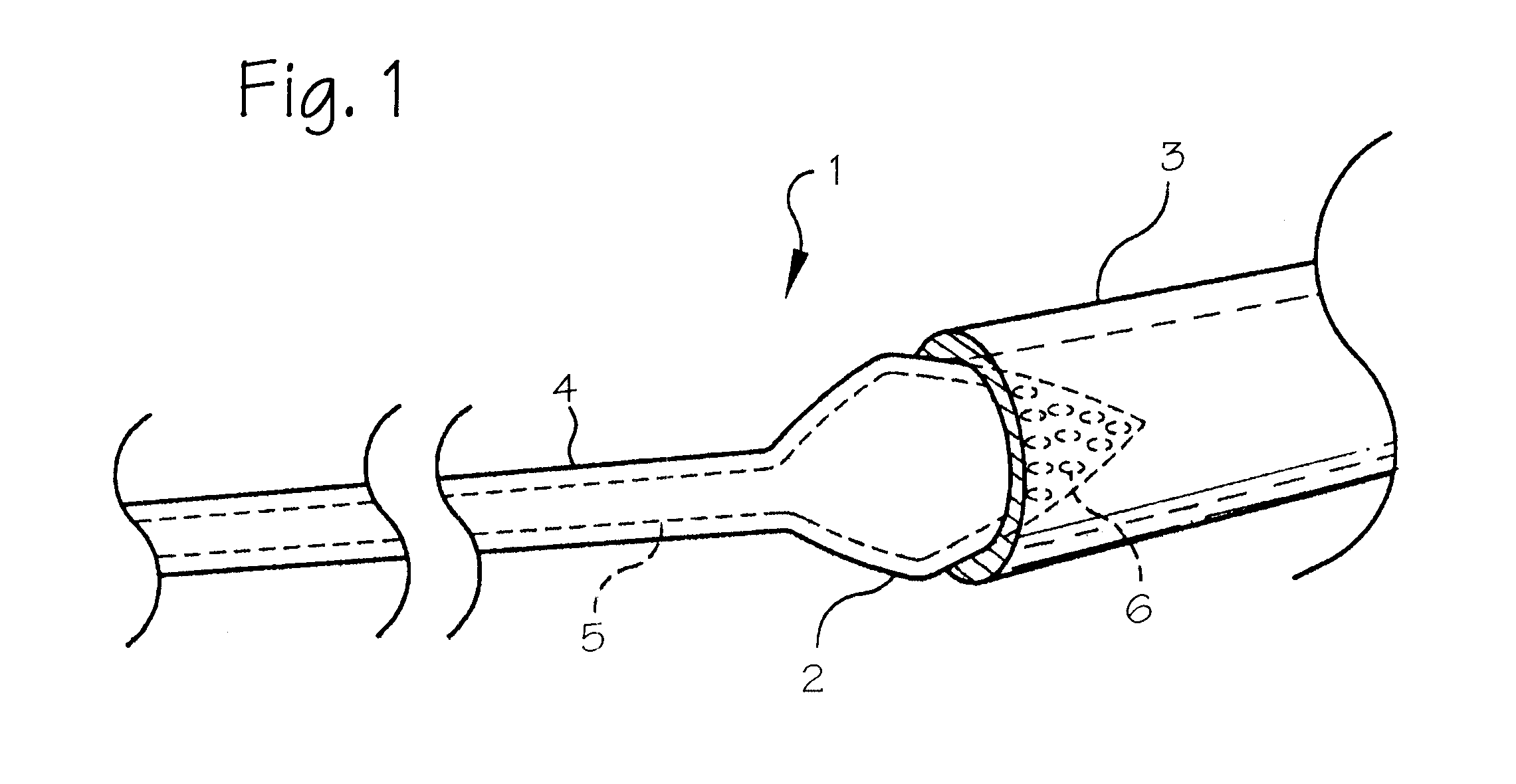 Pulmonary vein arrhythmia diagnostic device and method for use