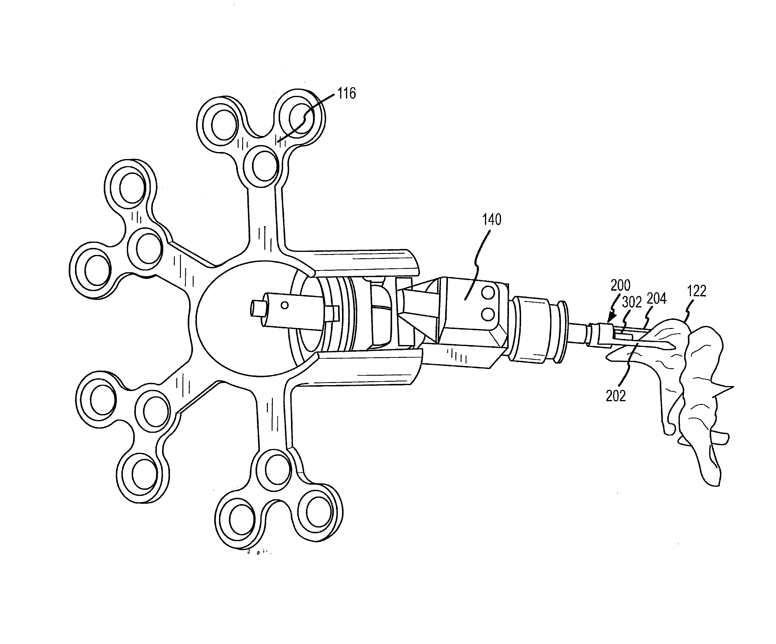 Compressive coupling of an implantable hearing aid actuator to an auditory component