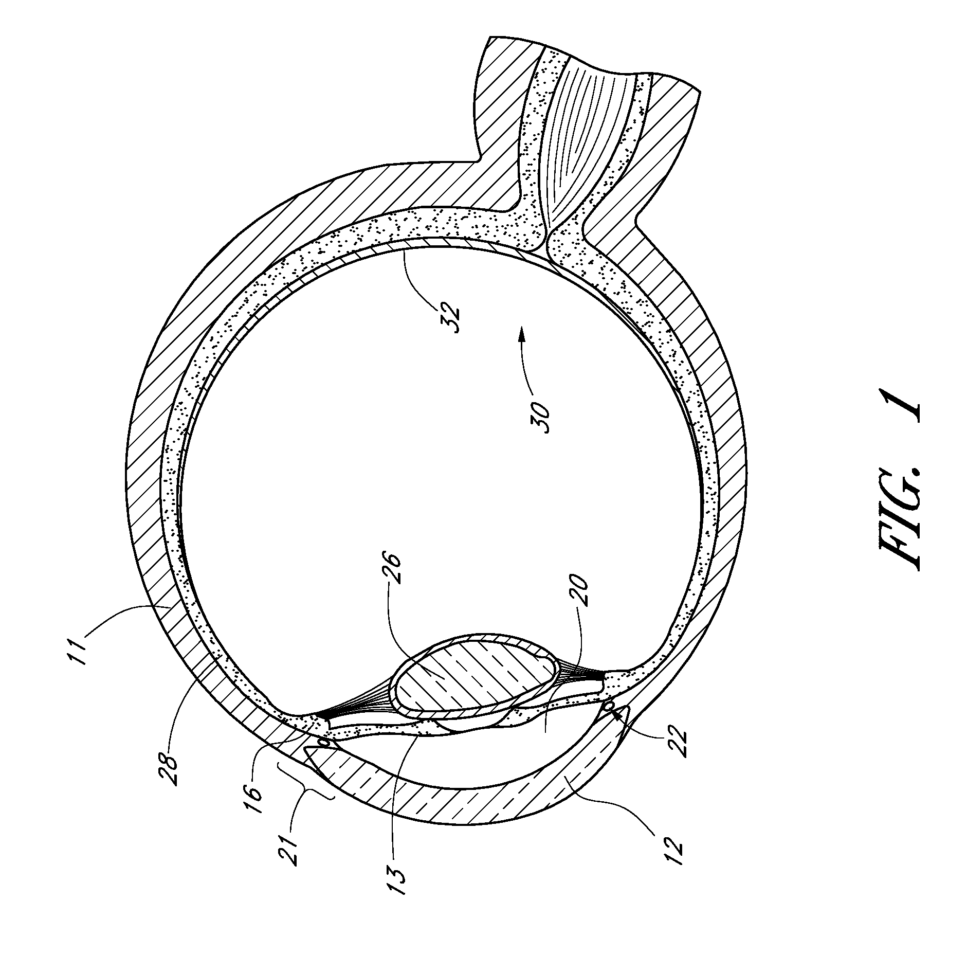 Drug eluting ocular implant