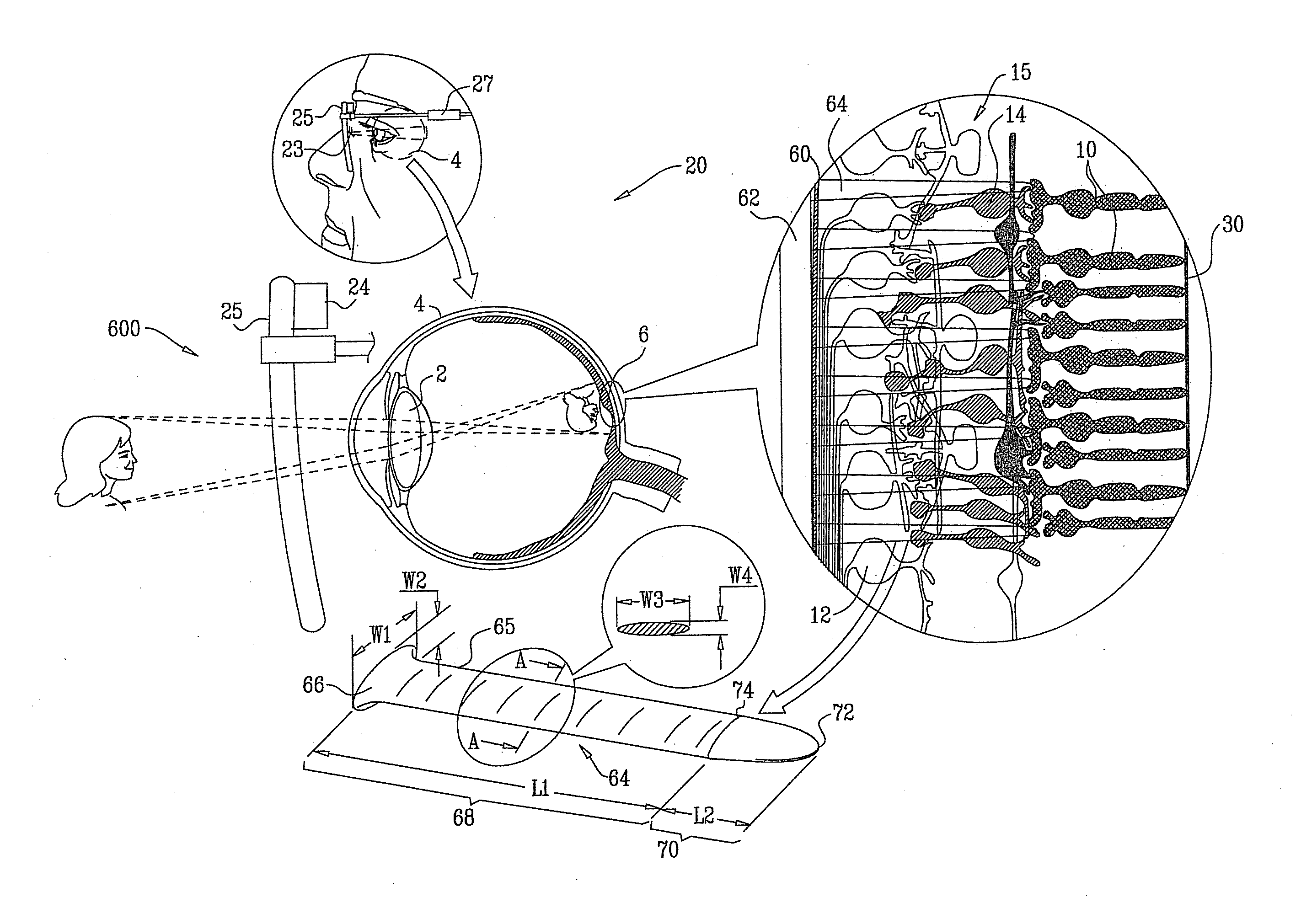 Retinal Prosthesis Techniques