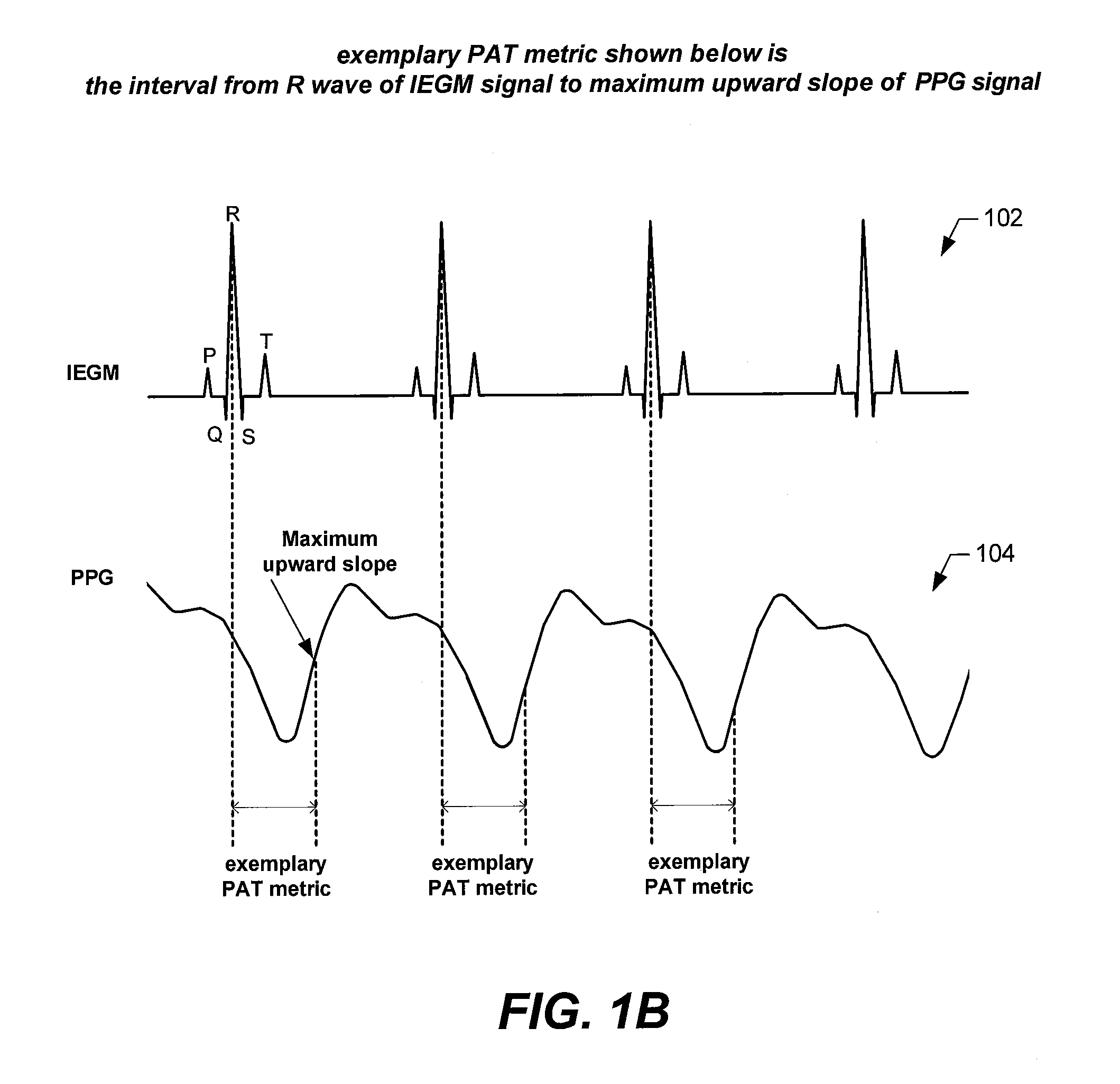 Implantable systems and methods for use therewith for monitoring and modifying arterial blood pressure without requiring an intravascular pressure transducer