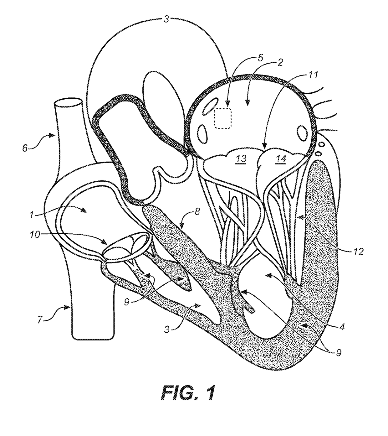 Catheter-guided replacement valves apparatus and methods