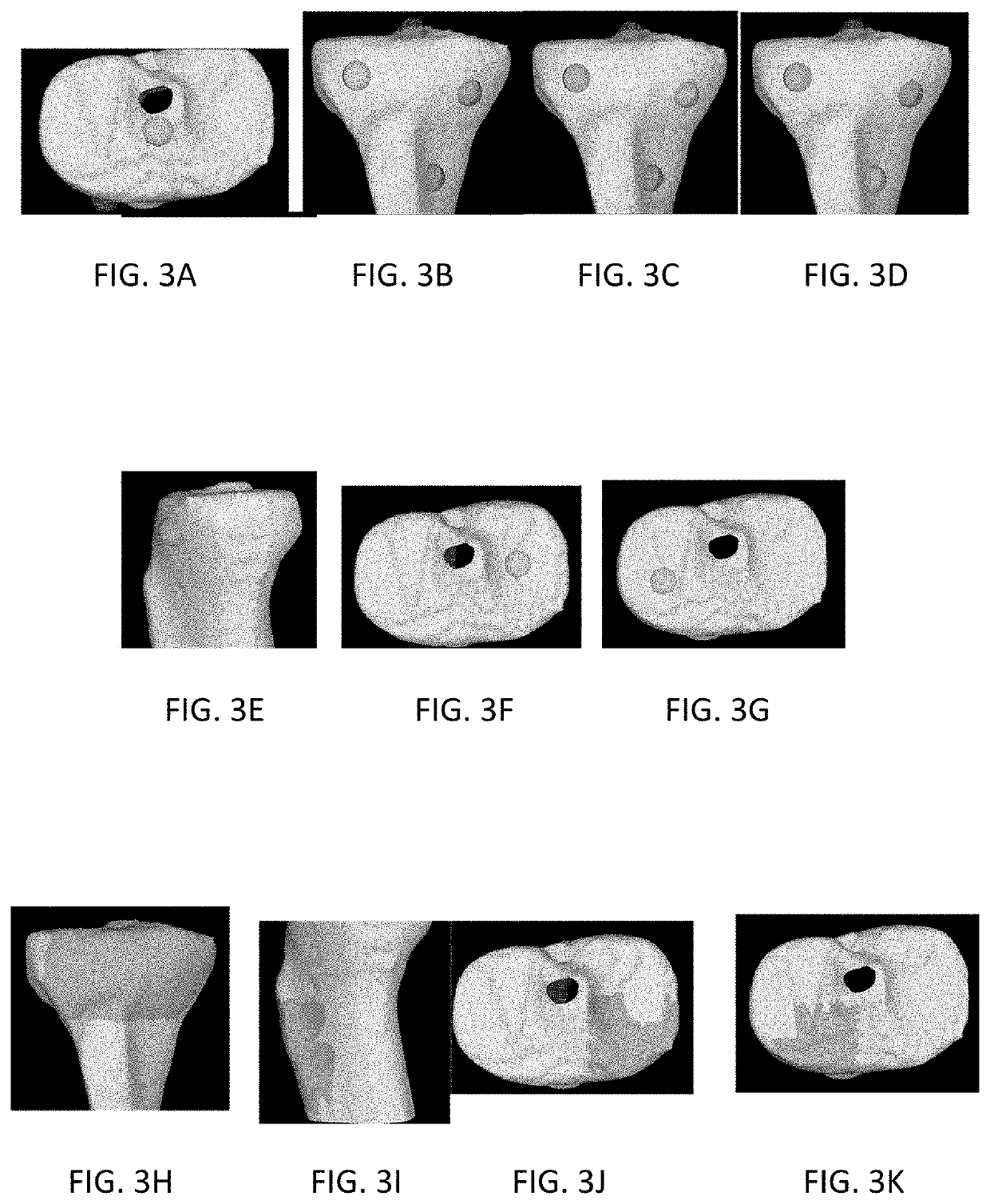 Bone registration methods for robotic surgical procedures