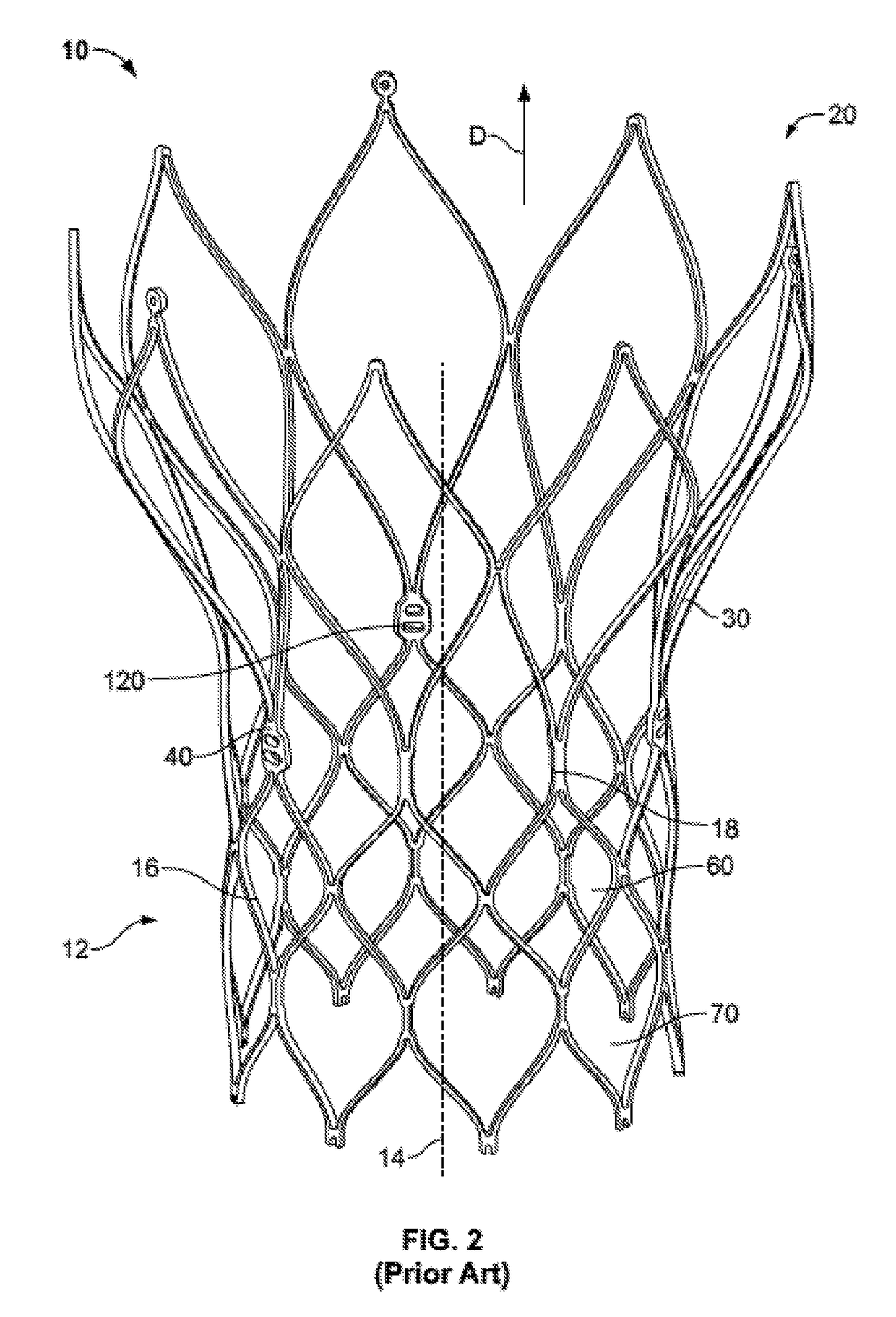 Transcatheter valve stent anchors