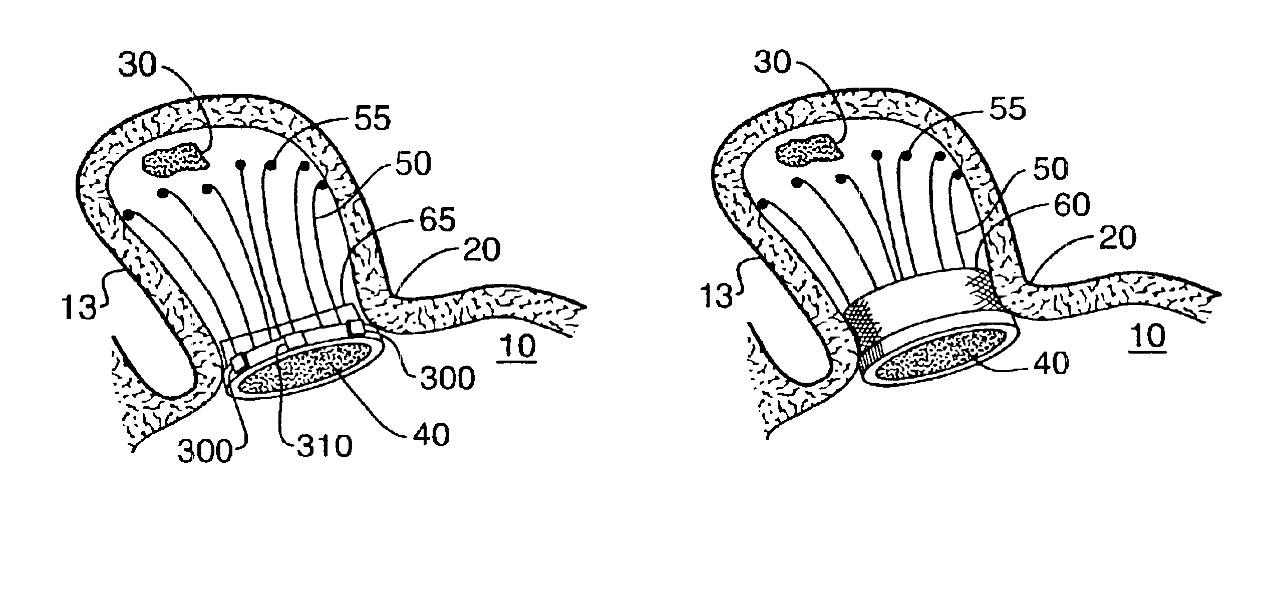 Barrier device for ostium of left atrial appendage