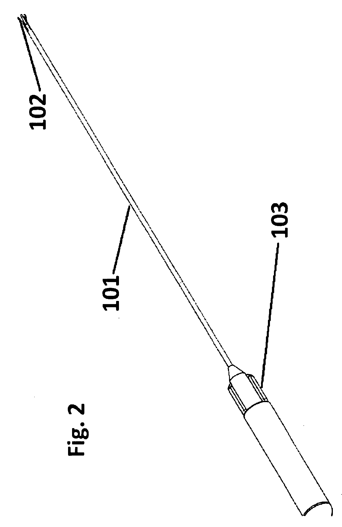 Retrievable urethra sparing prosthetic stent and kidney stone intervention system