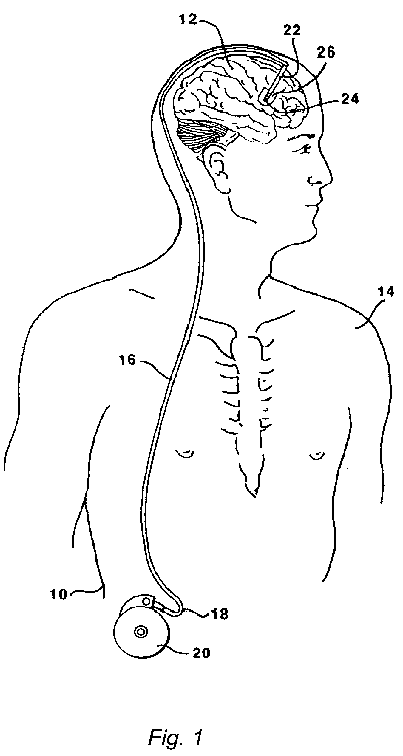 Methods and systems for treatment of neurological diseases of the central nervous system