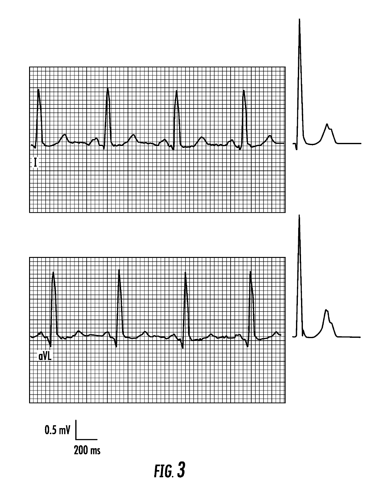 Method for computationally predicting optimal placement sites for internal defibrillators in pediatric and congenital heart defect patients