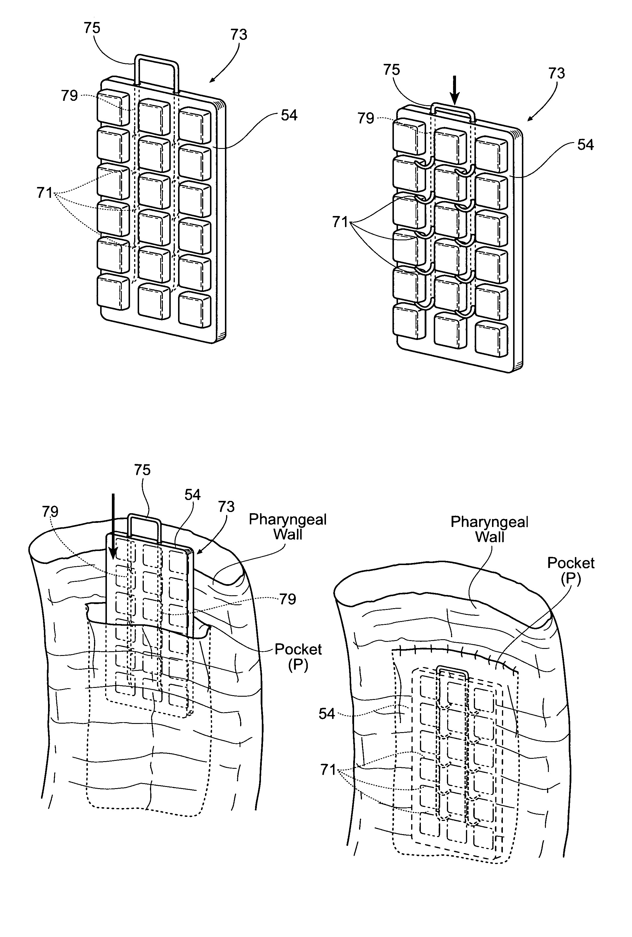 Devices, systems, and methods for stabilization or fixation of magnetic force devices used in or on a body