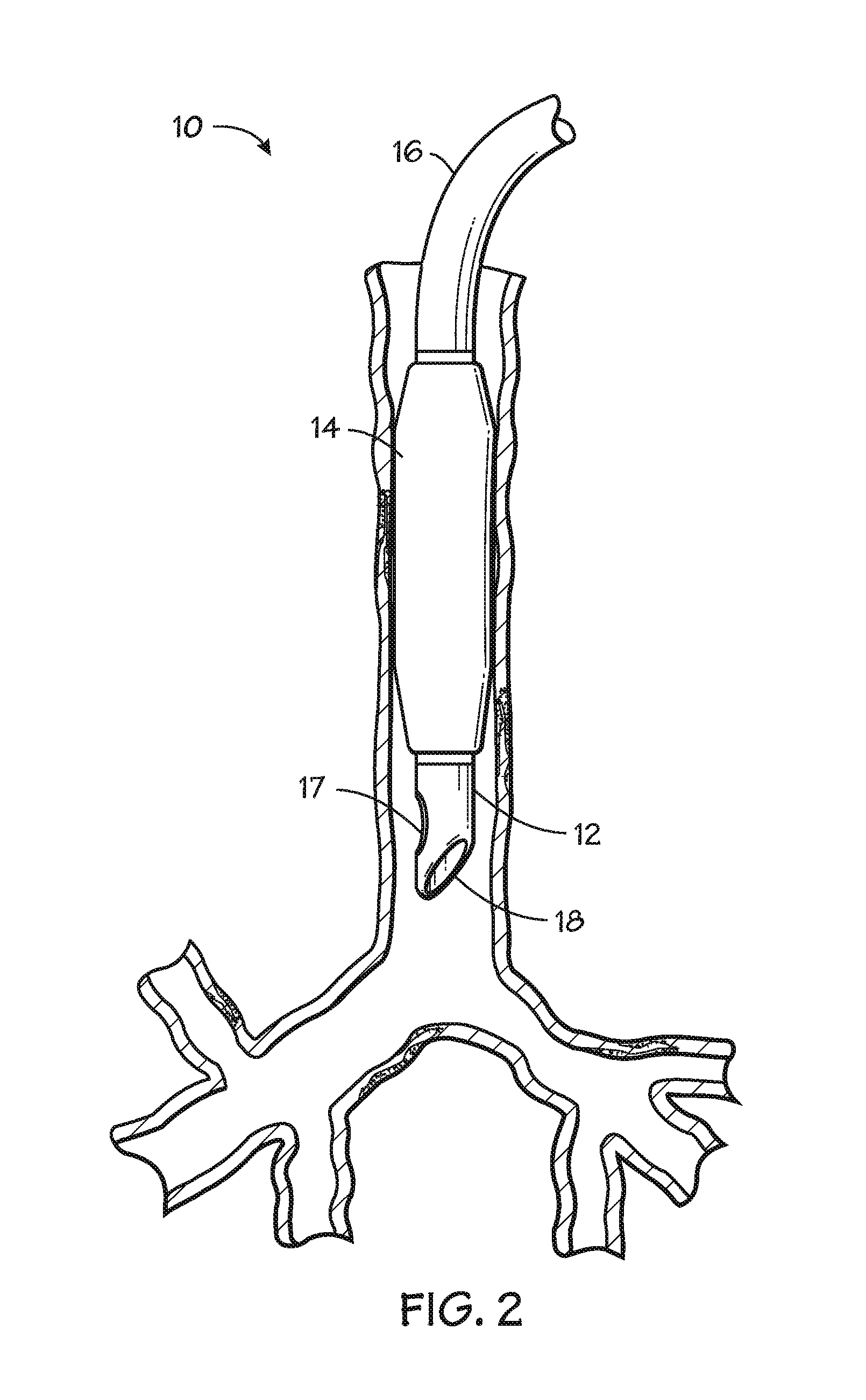 Self-sizing adjustable endotracheal tube