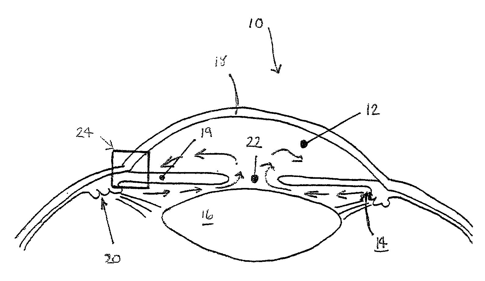 Method and apparatus for treatment of glaucoma