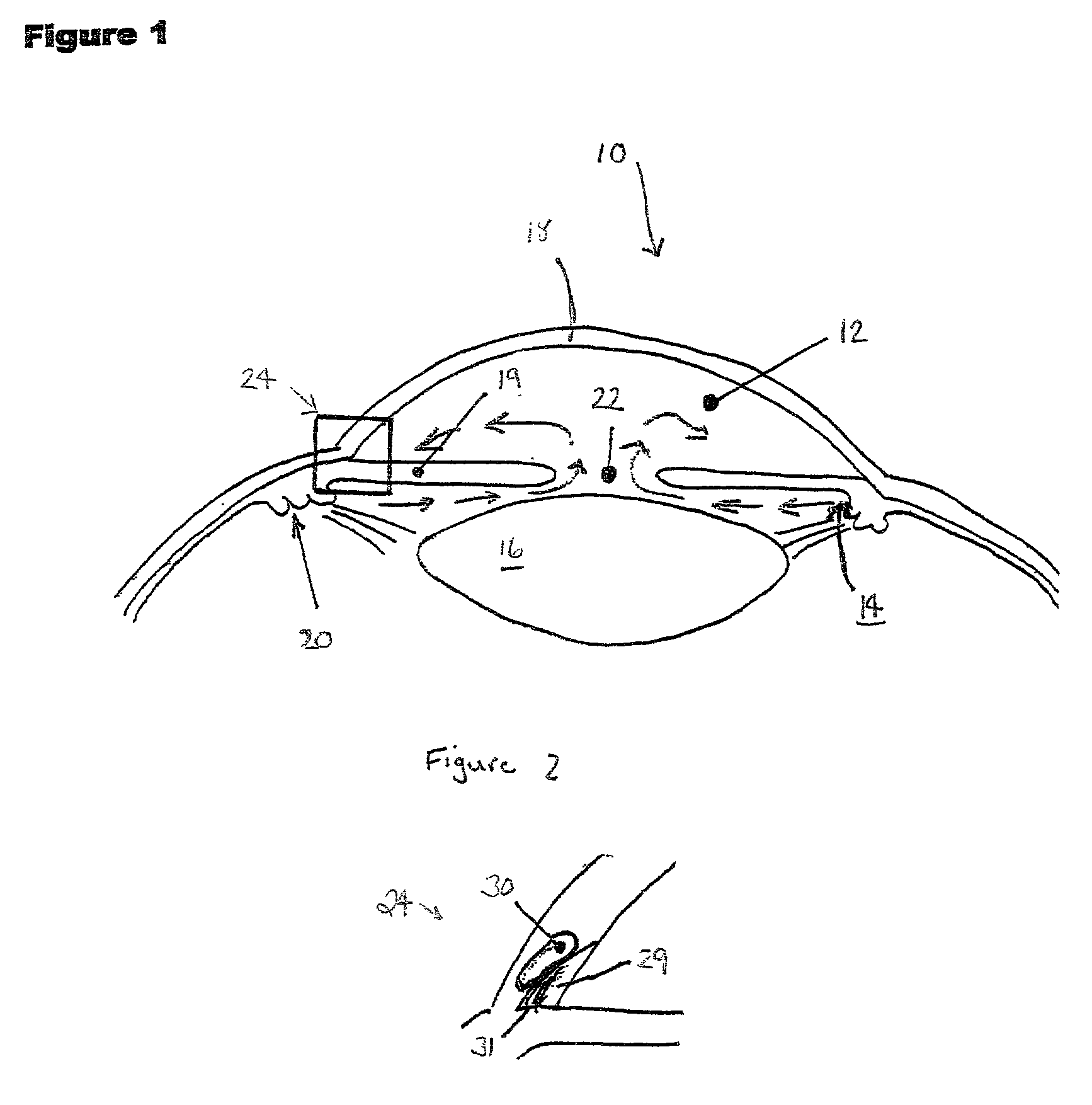 Method and apparatus for treatment of glaucoma