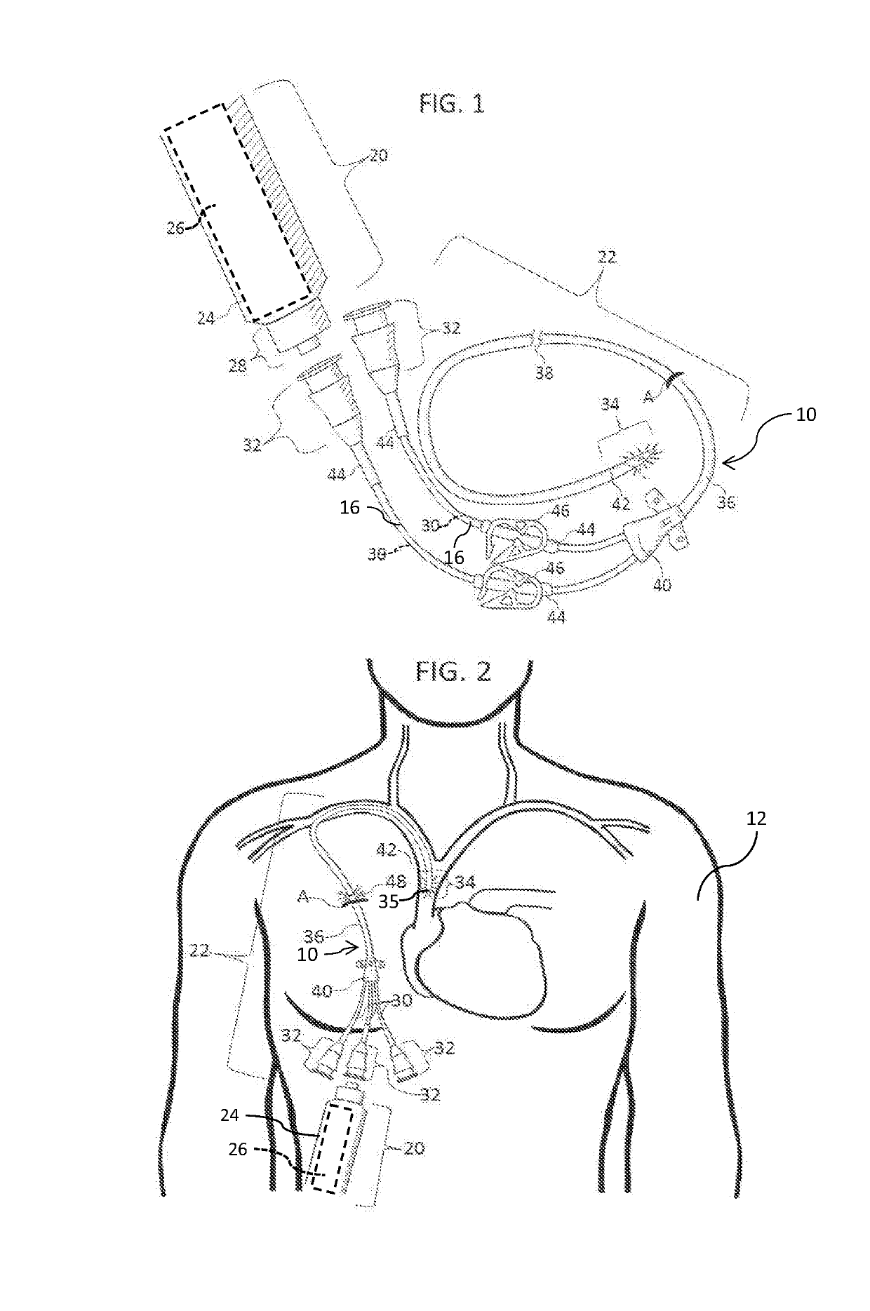 Methods and apparatus to deliver therapeutic, non-ultraviolet electromagnetic radiation to inactivate infectious agents and/or to enhance healthy cell growth via a catheter residing in a body cavity