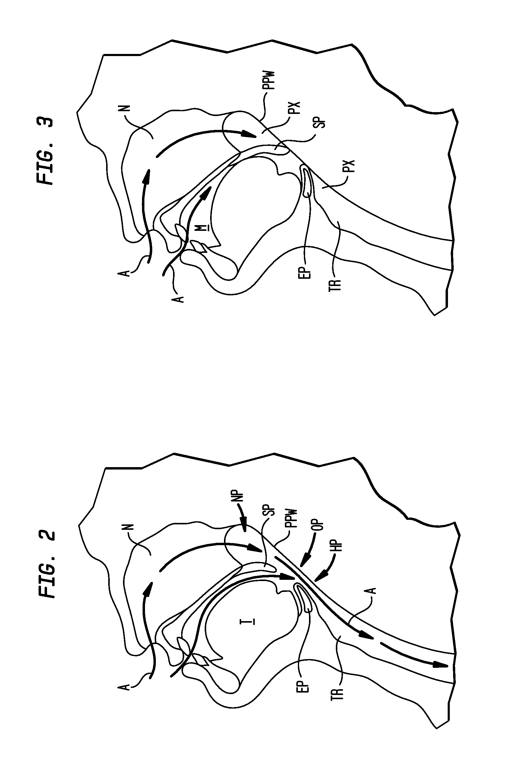 Methods and devices for the indirect displacement of the hyoid bone for treating obstructive sleep apnea