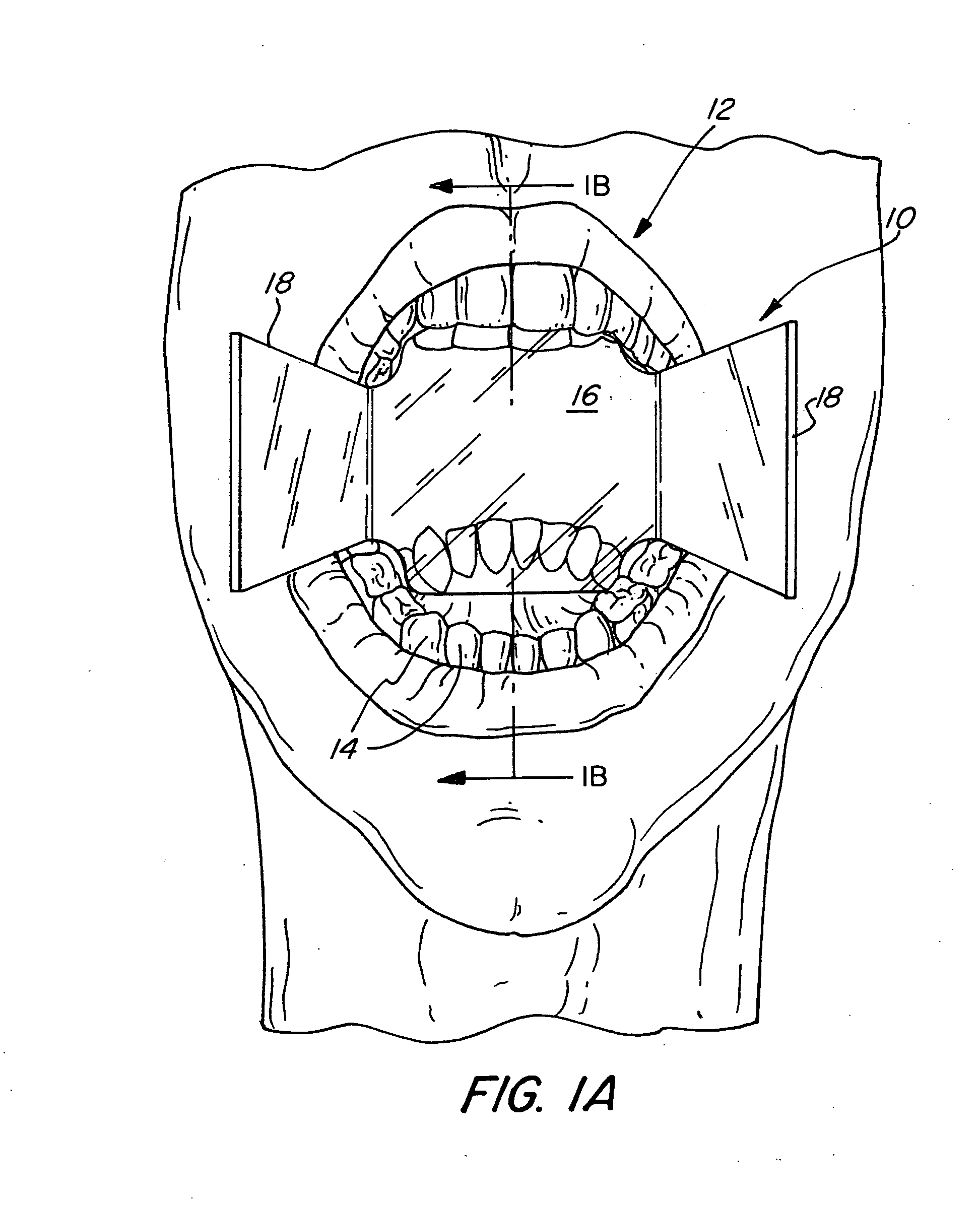 Dental bilatetal bite block