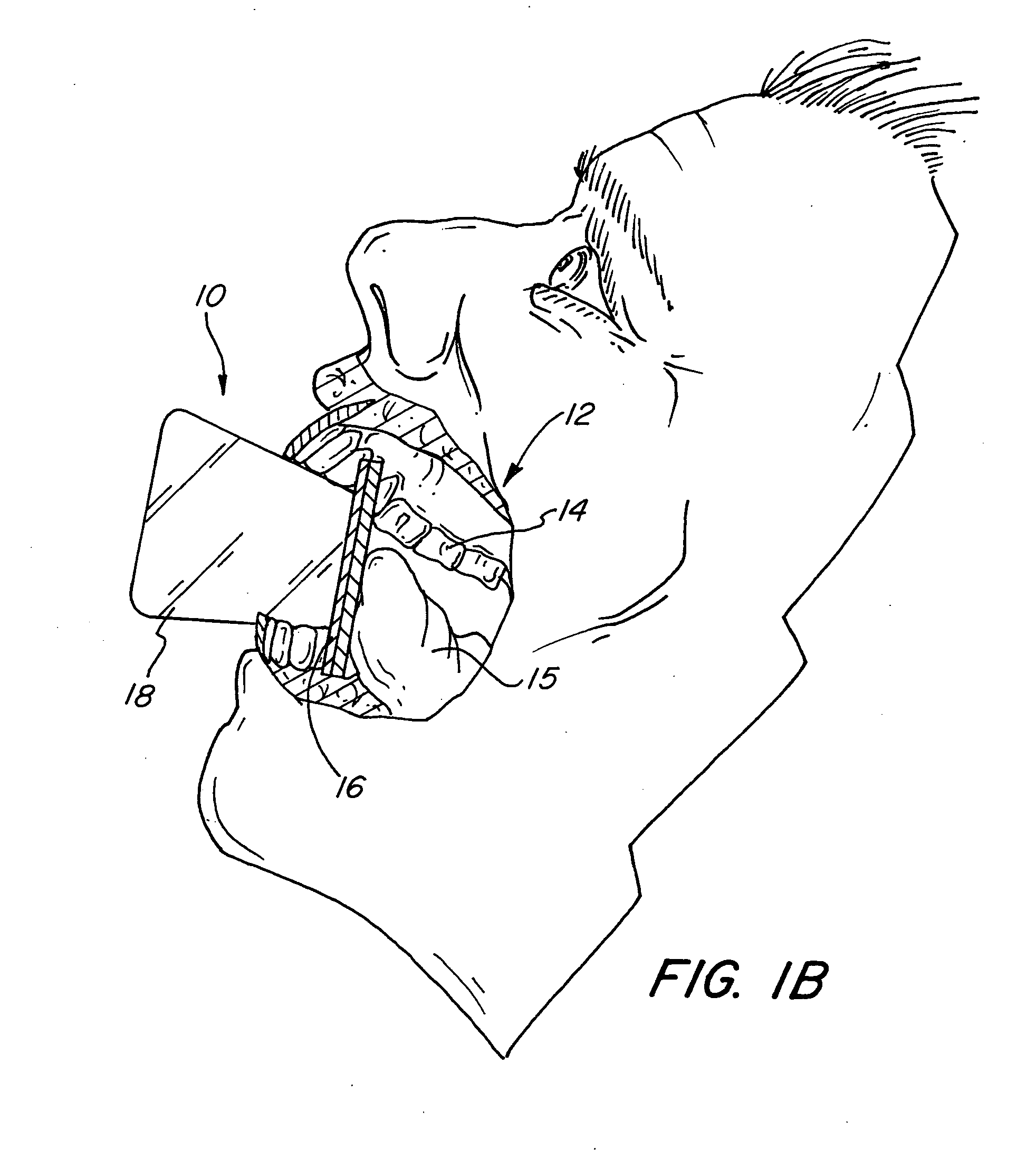 Dental bilatetal bite block