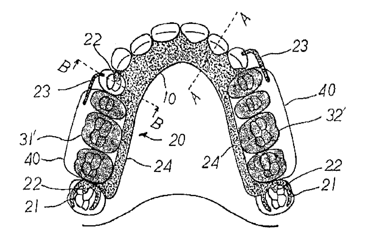 Removable denture with metal denture tooth or teeth