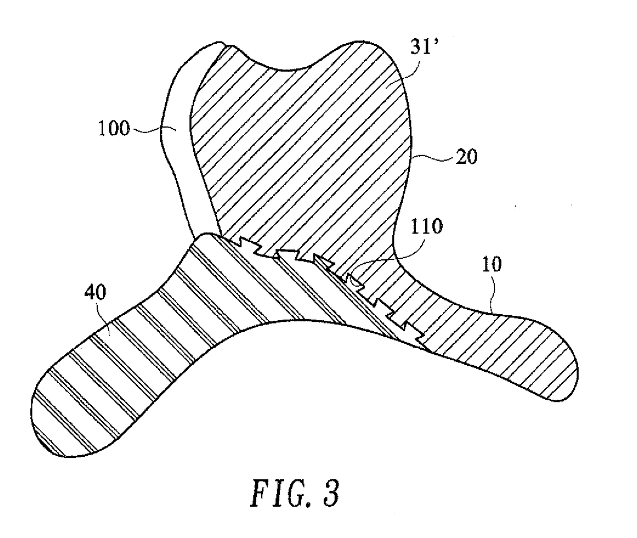 Removable denture with metal denture tooth or teeth