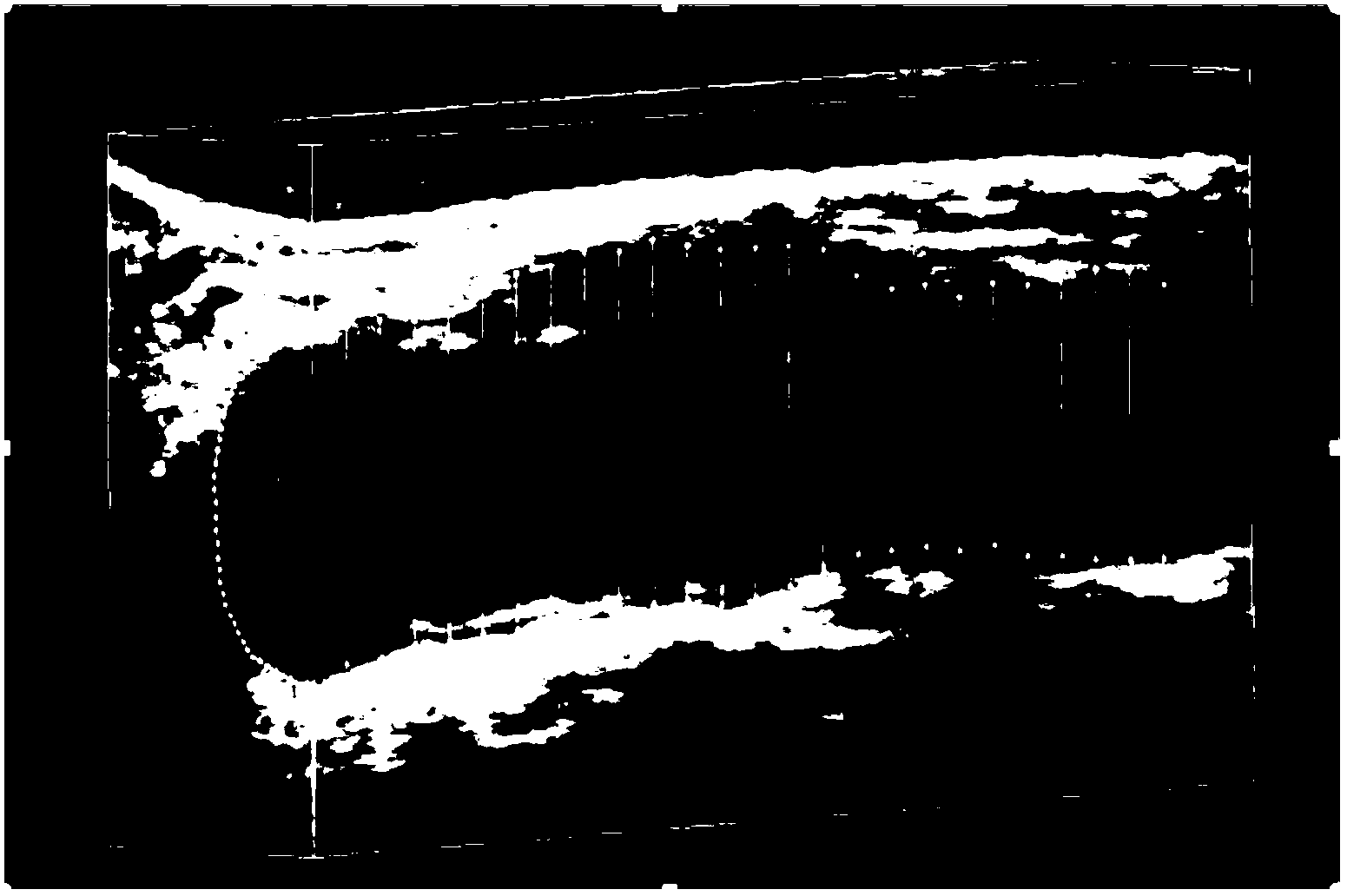 Automatic dividing method of ultrasound carotid artery vascular membrane