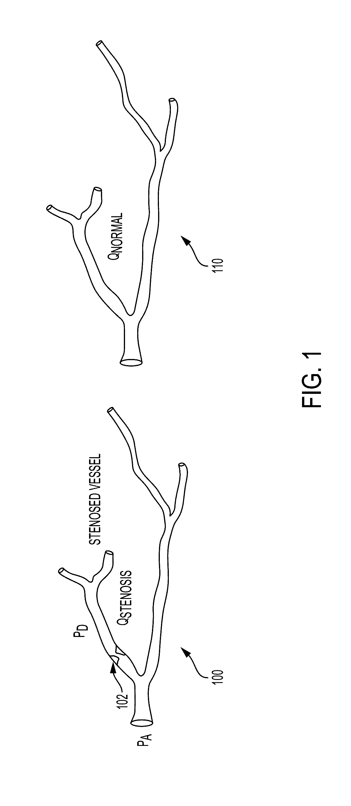 Method and System for Non-Invasive Functional Assessment of Coronary Artery Stenosis Using Flow Computations in Diseased and Hypothetical Normal Anatomical Models