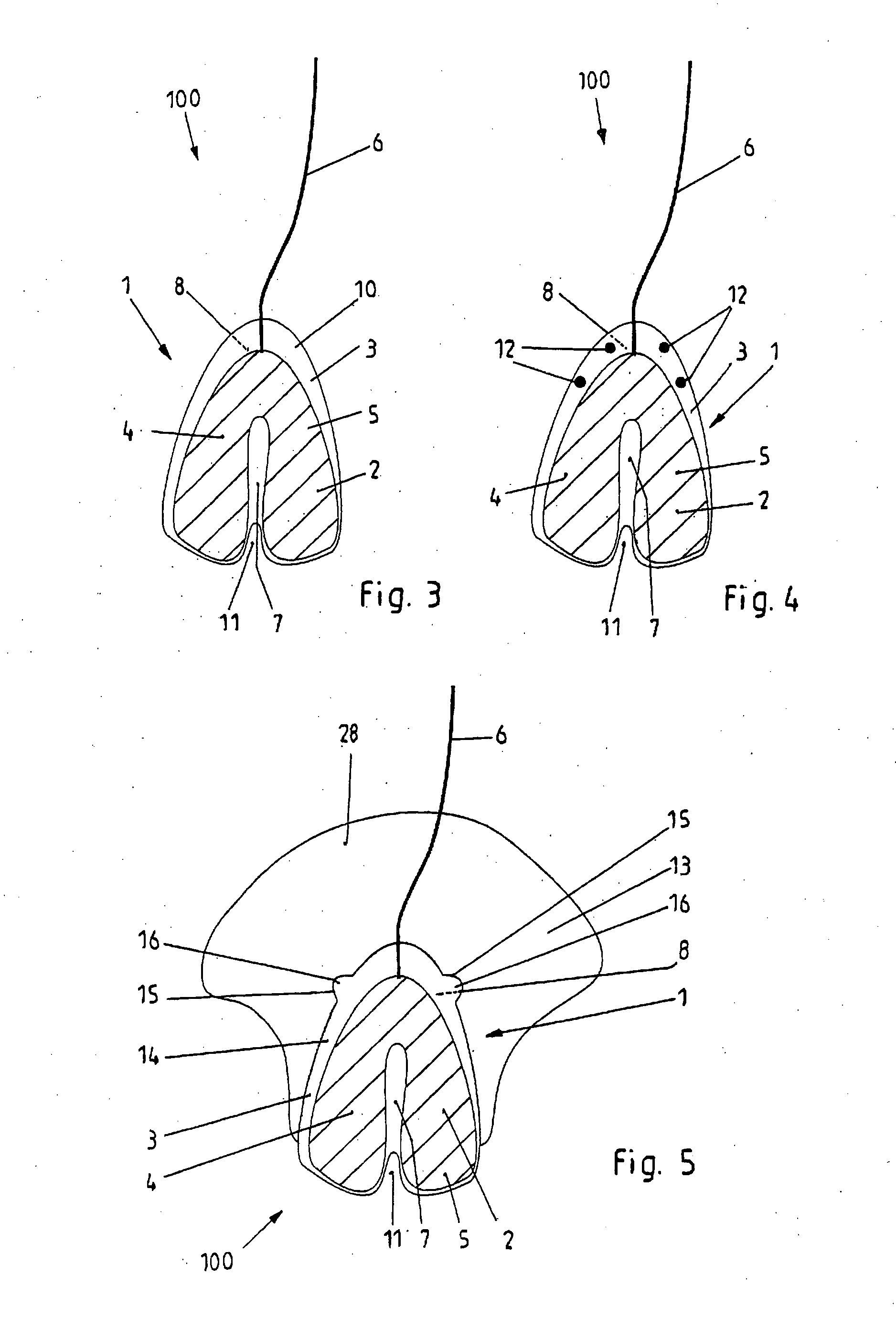 Apparatus for submental electrical stimulation of the supra hyoid muscles of the floor of mouth