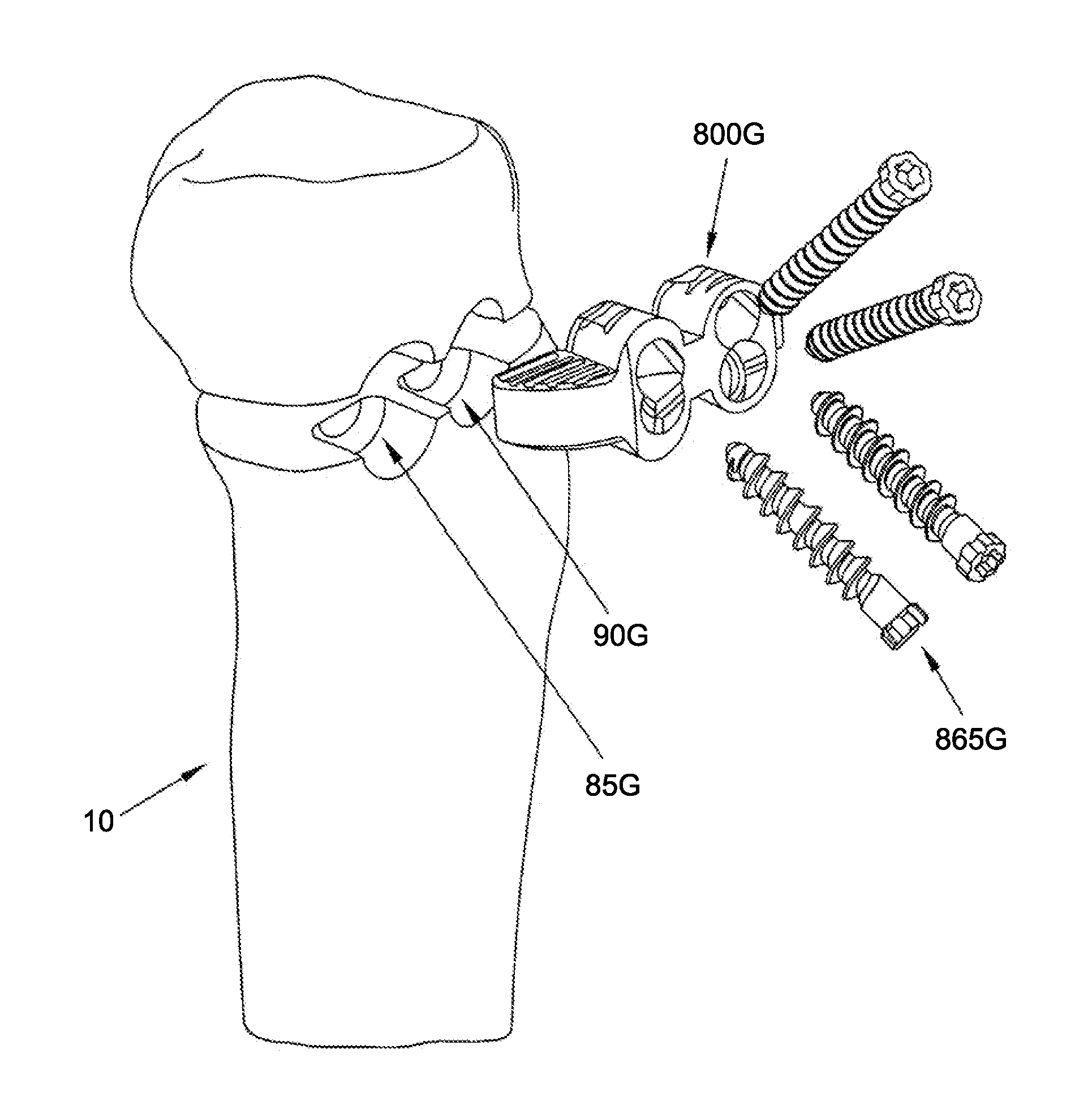 Method and apparatus for performing an open wedge, high tibial osteotomy