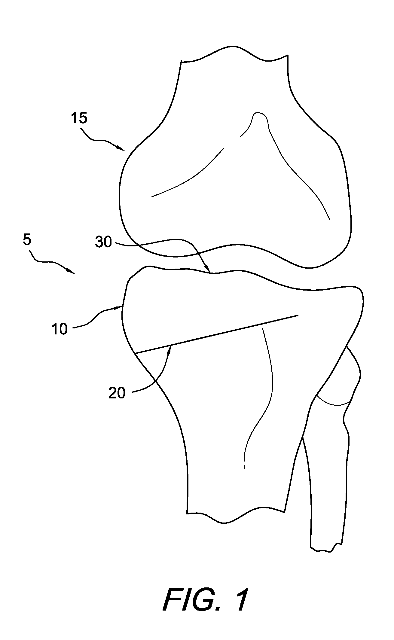 Method and apparatus for performing an open wedge, high tibial osteotomy