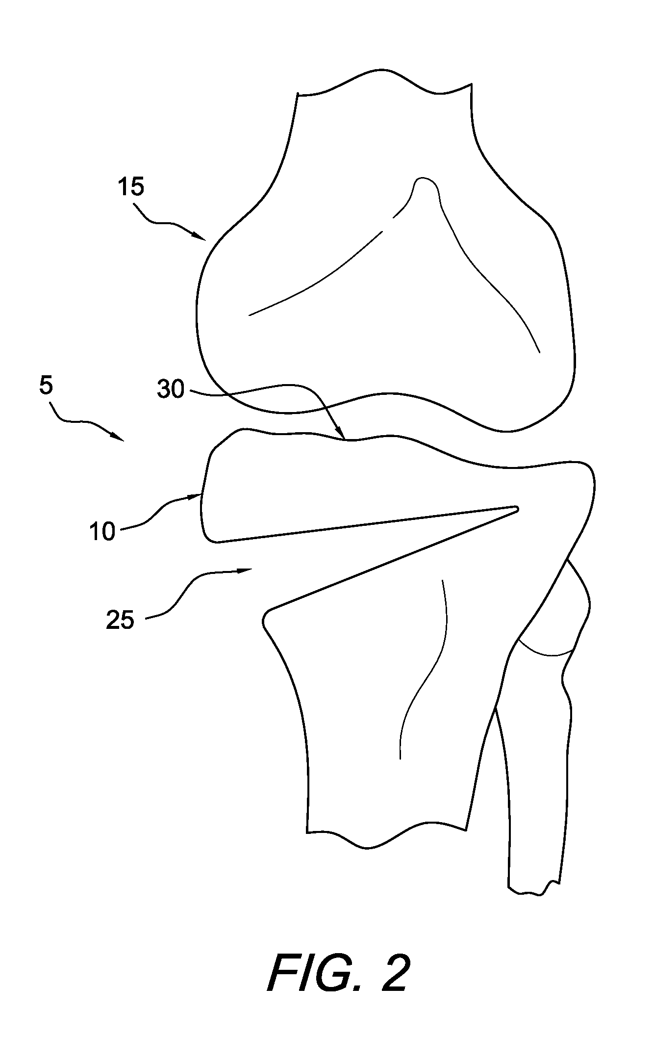 Method and apparatus for performing an open wedge, high tibial osteotomy