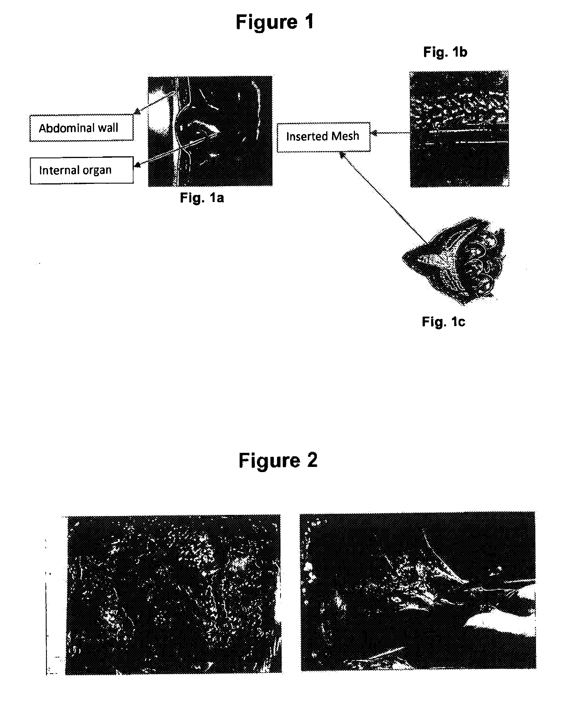 Multi-layered surgical prosthesis