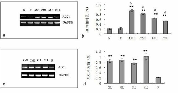 Application of ALC1 to preparation of leukaemia drug resistance reversing agent and as drug-resistant leukaemia diagnosing reagent