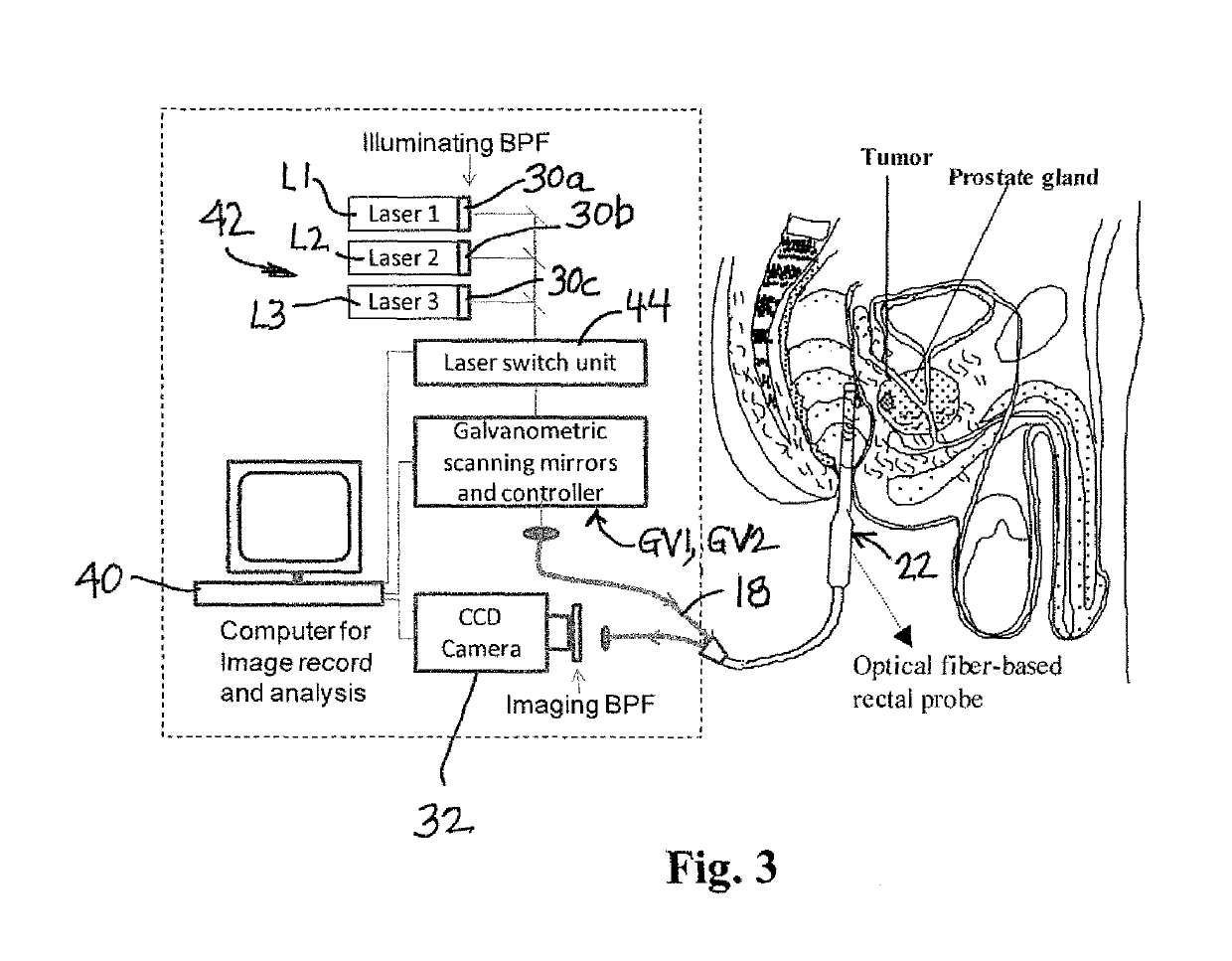 Near infrared photonic prostatoscopy analyzer