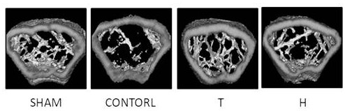 Application of higenamine hydrochloride in preparation of medicine for treating osteoporosis