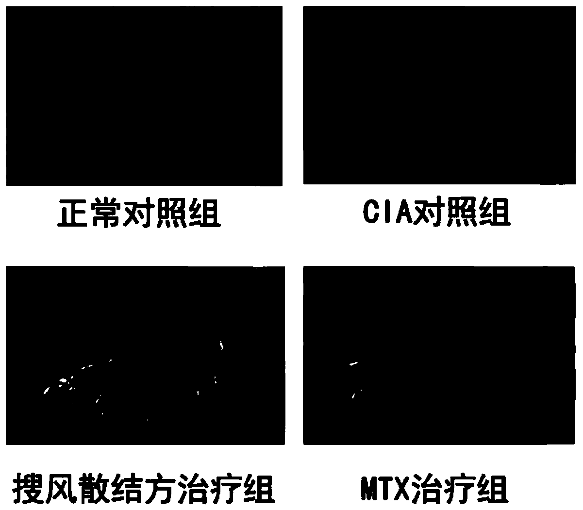 Wind-dispelling stagnation-eliminating traditional Chinese medicine composition and application thereof